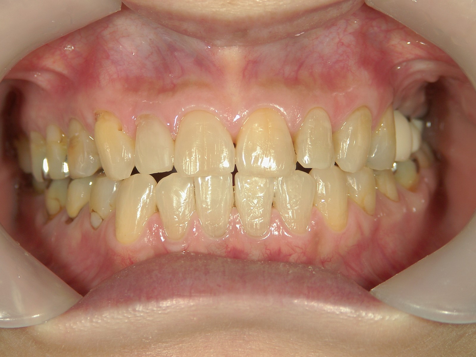 非抜歯症例（10）