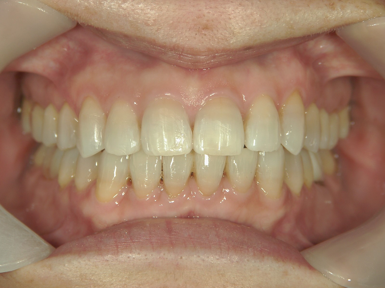 非抜歯症例（12）