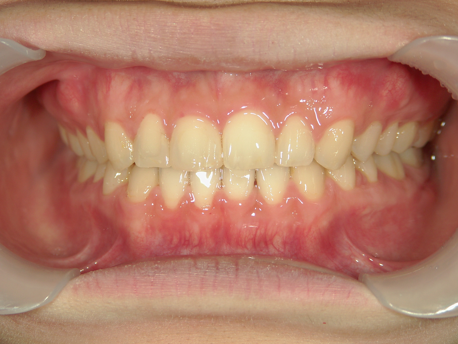 非抜歯症例（13）