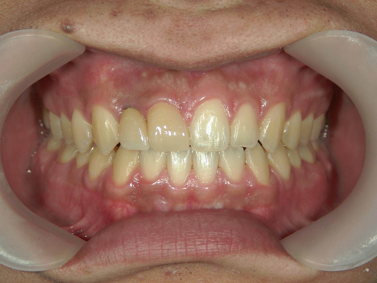 全顎ワイヤー矯正　症例（69）