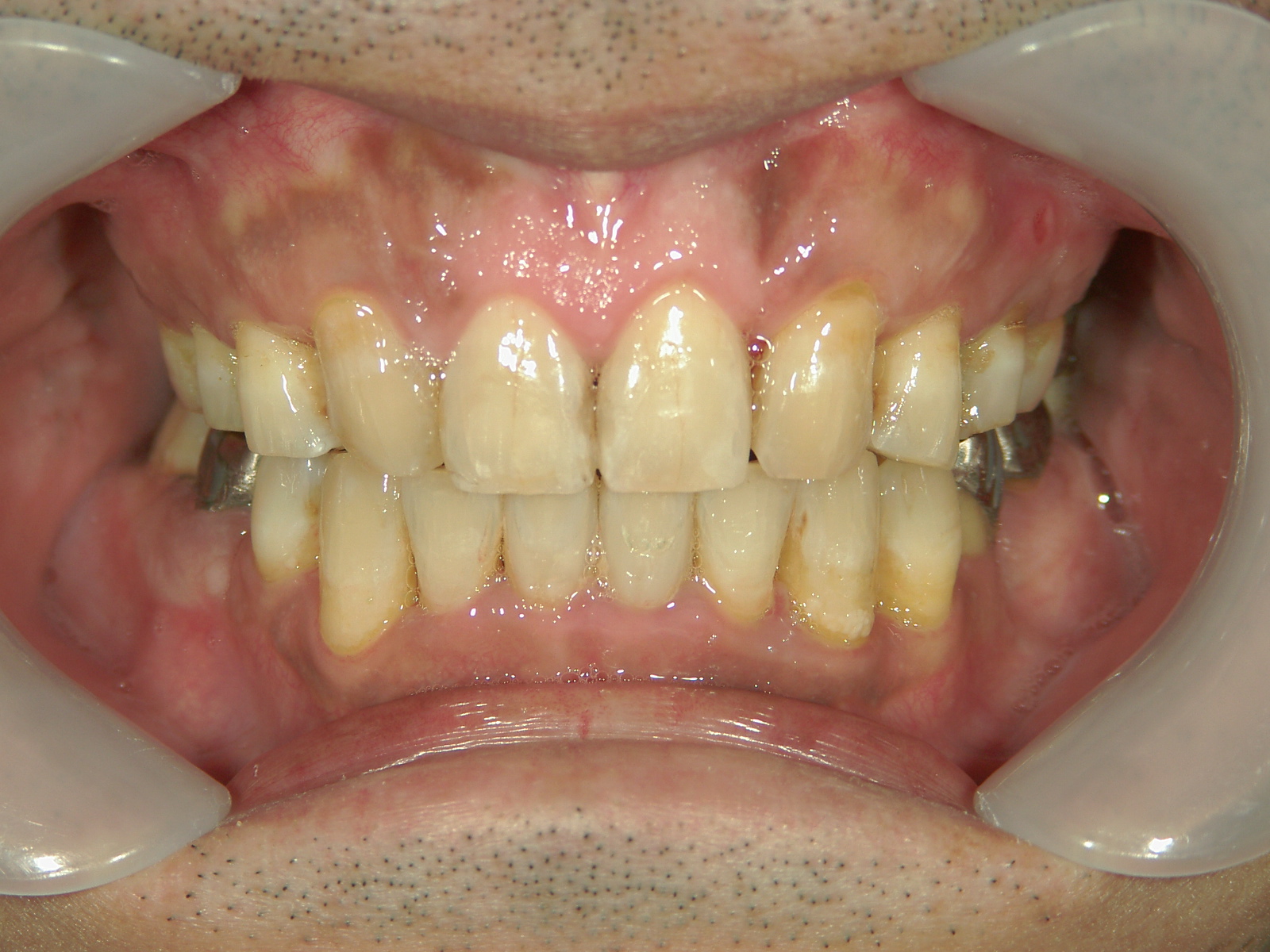 全顎ワイヤー矯正　症例（72）