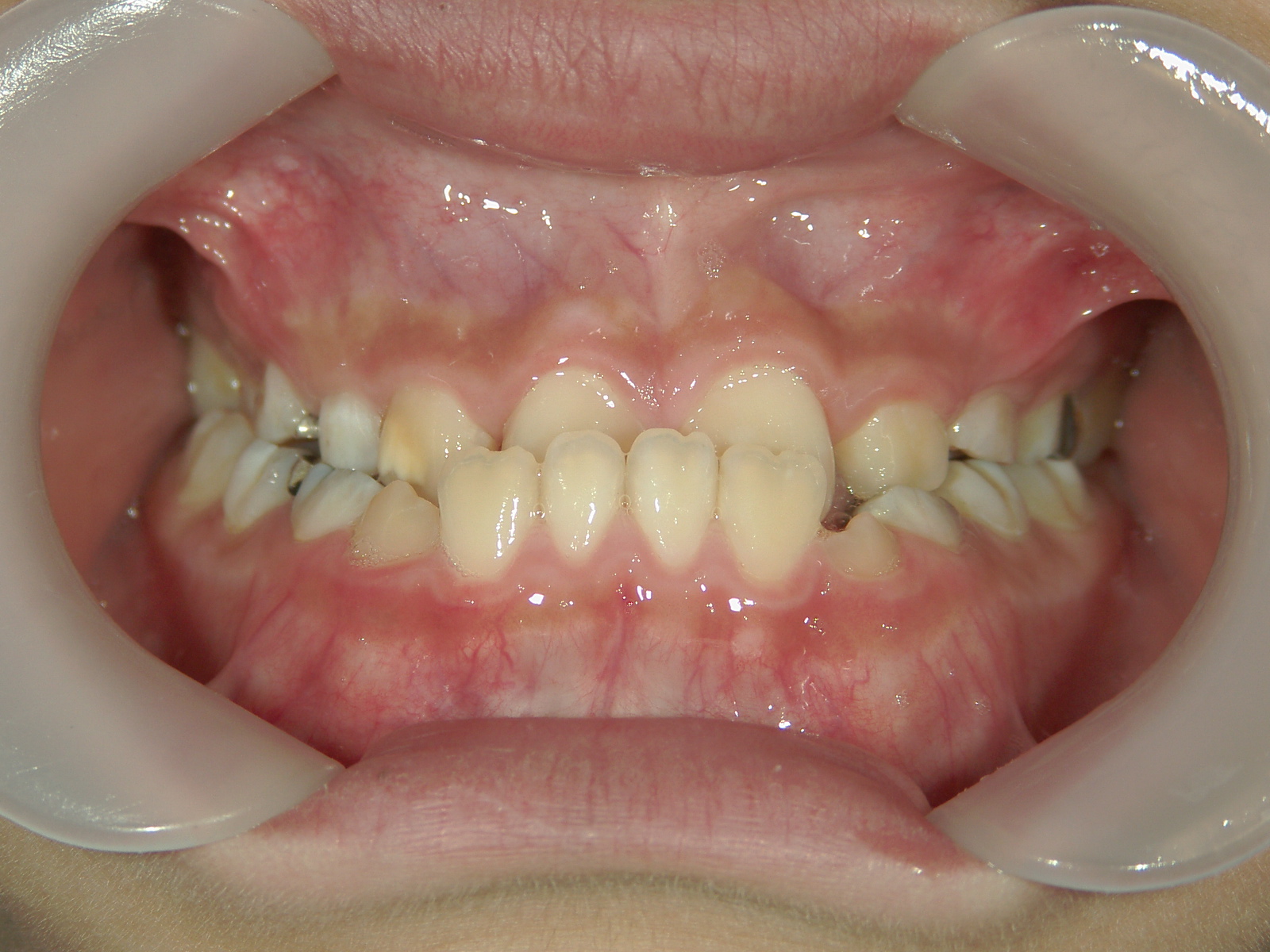 非抜歯症例（1）