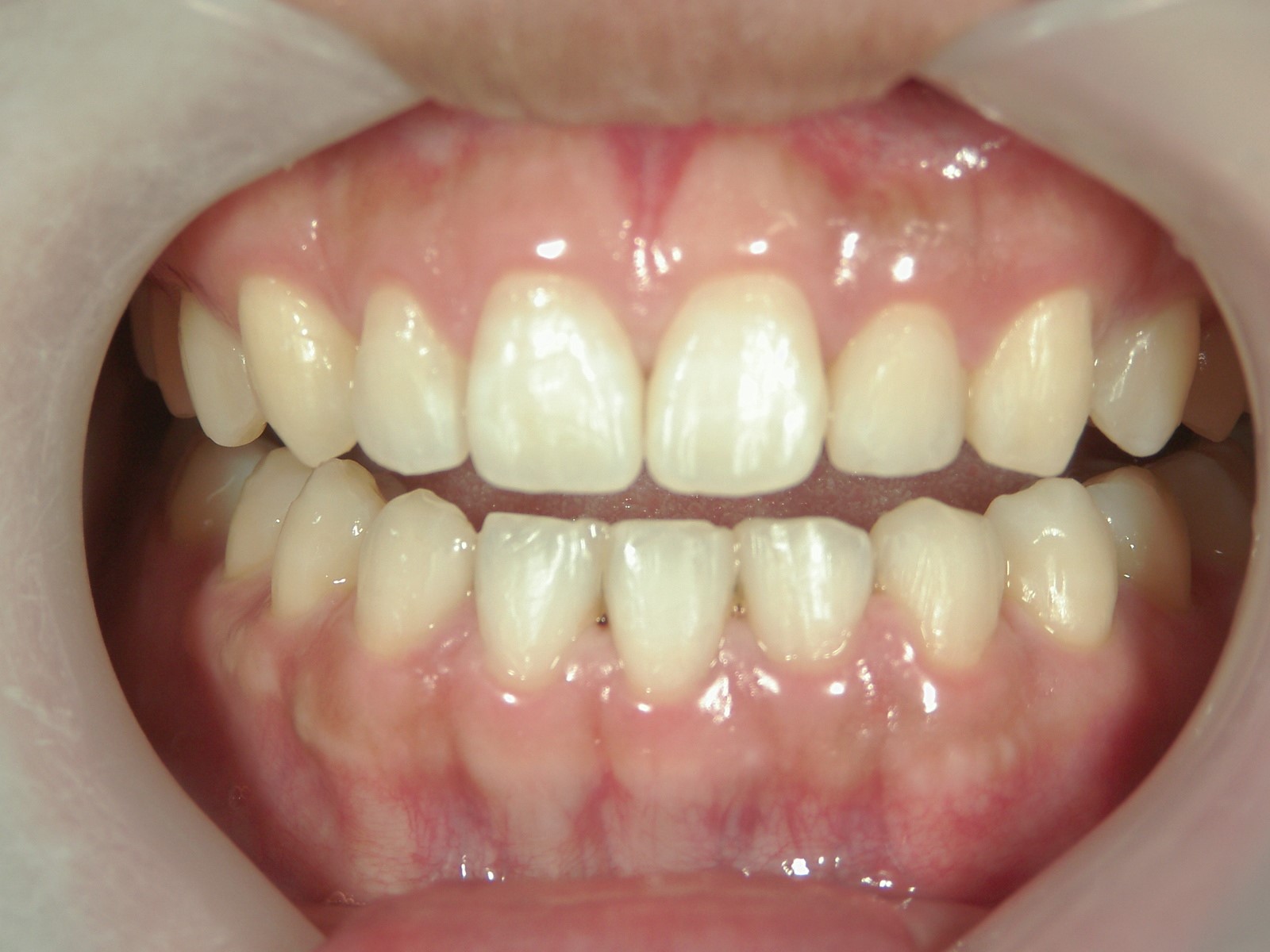 非抜歯症例（11）