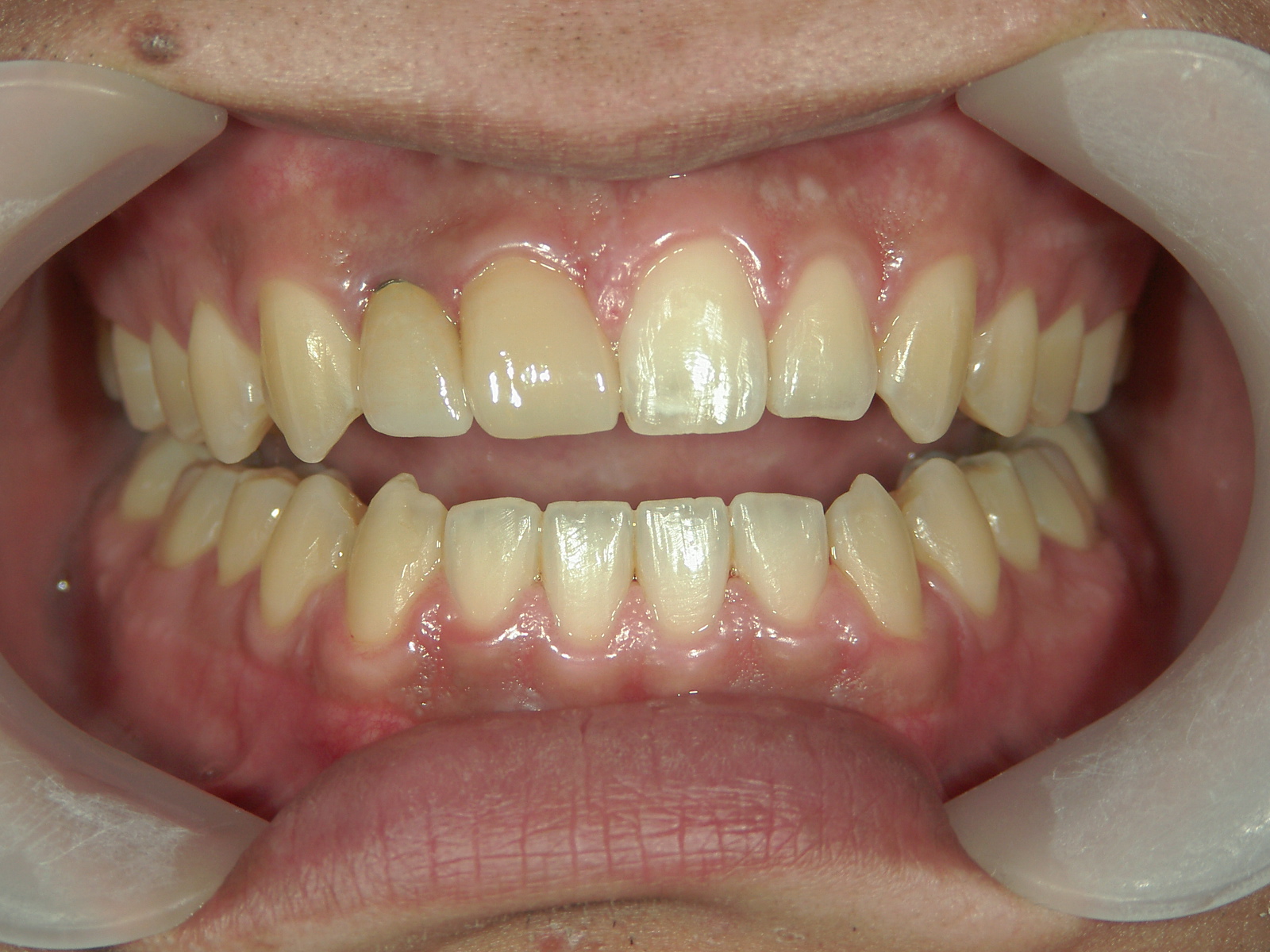 全顎ワイヤー矯正　症例（69）