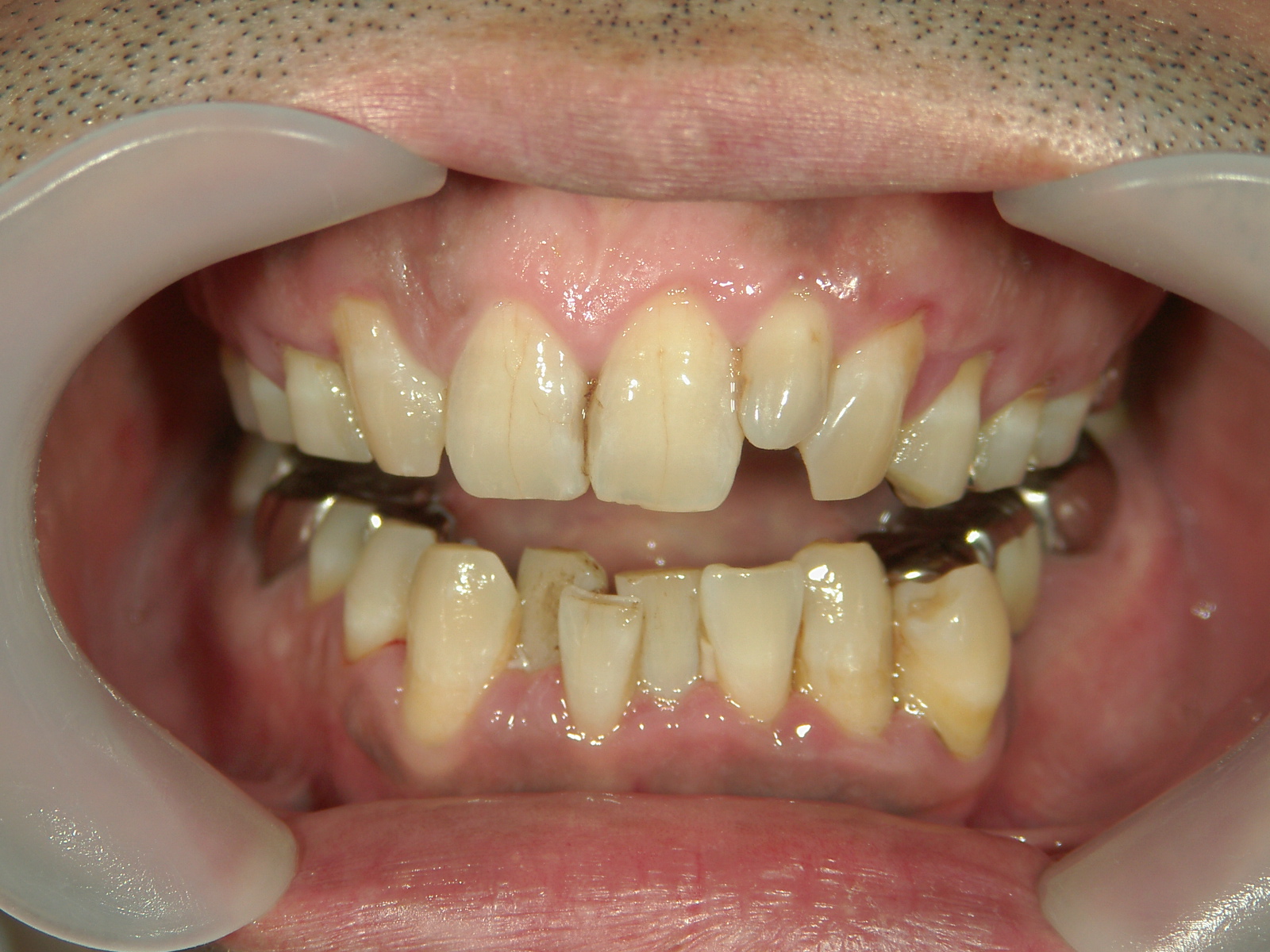 全顎ワイヤー矯正　症例（72）