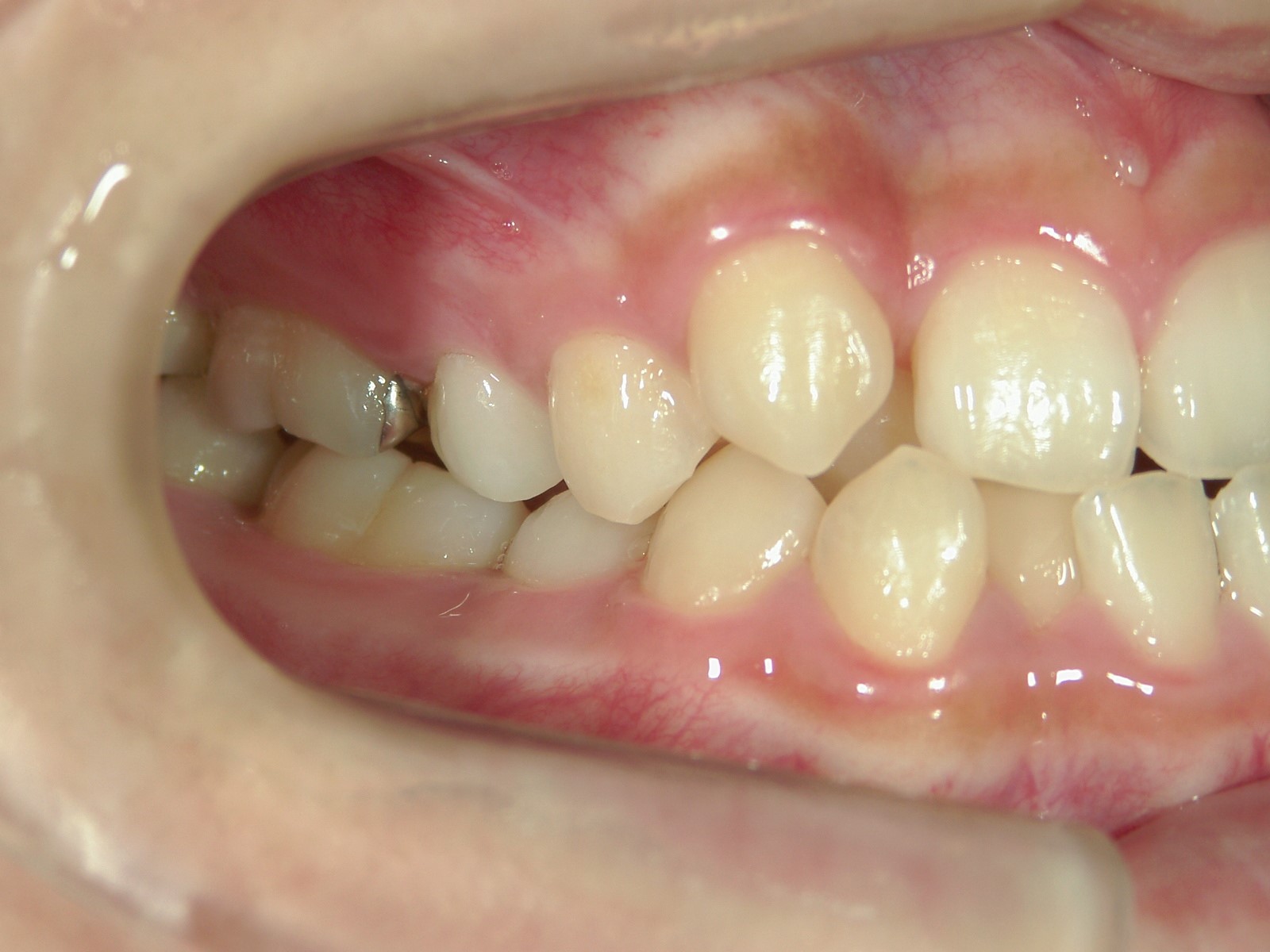 非抜歯症例（4）