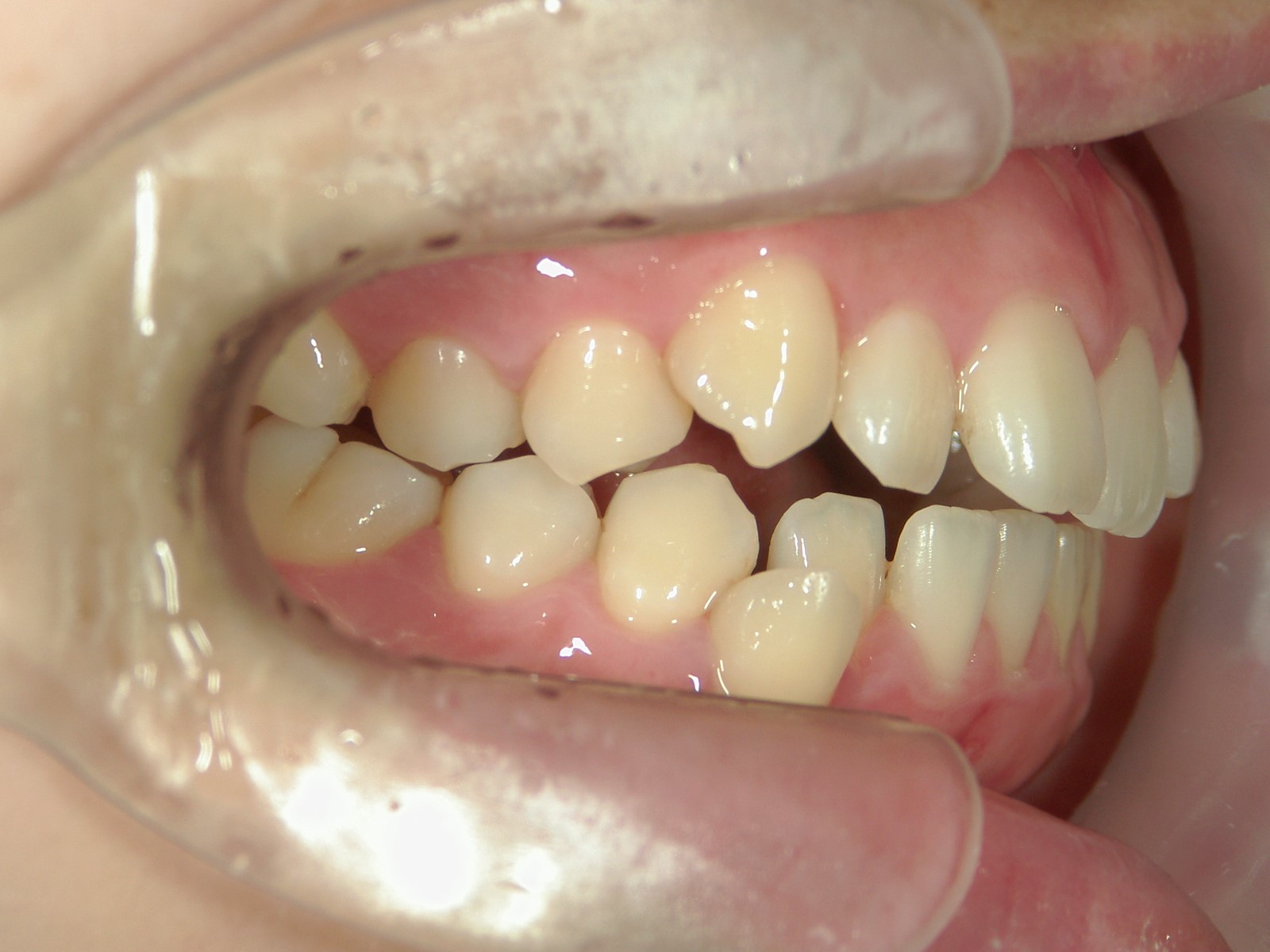 非抜歯症例（5）