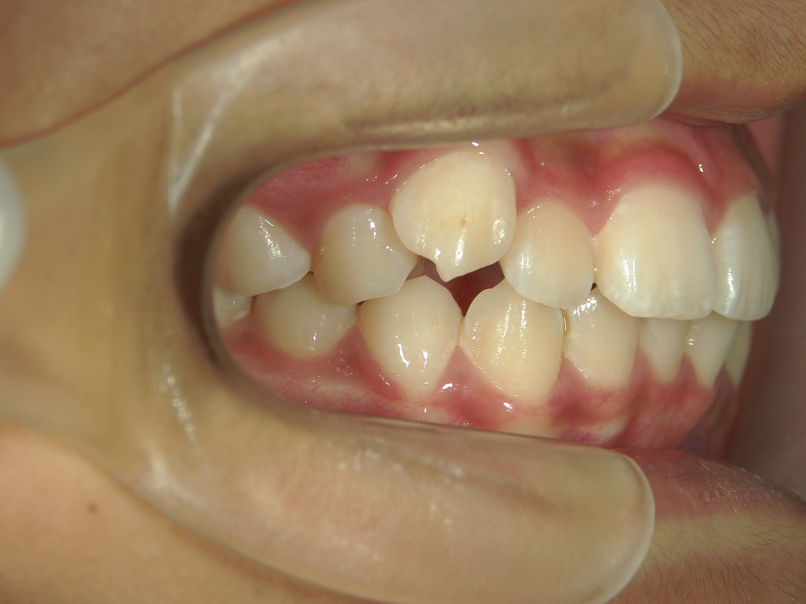 非抜歯症例（9）