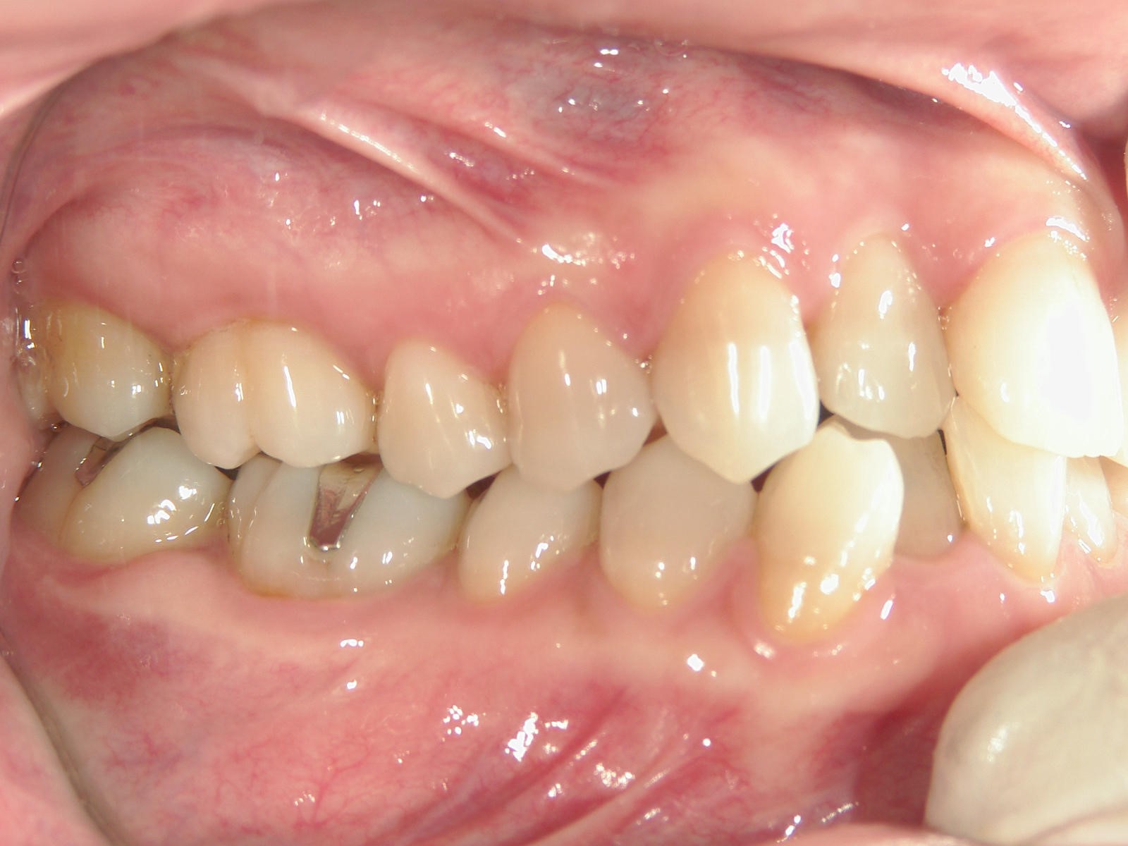 非抜歯症例（12）