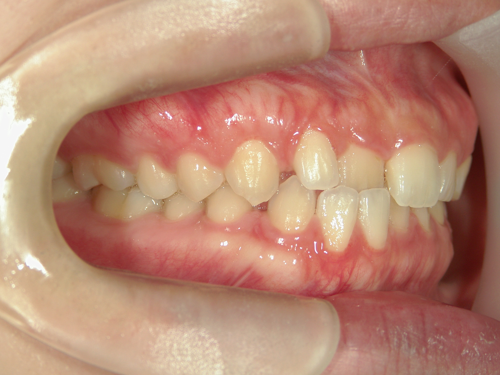 非抜歯症例（13）
