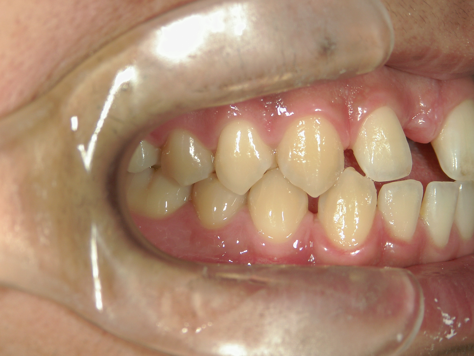 全顎ワイヤー矯正　症例（69）