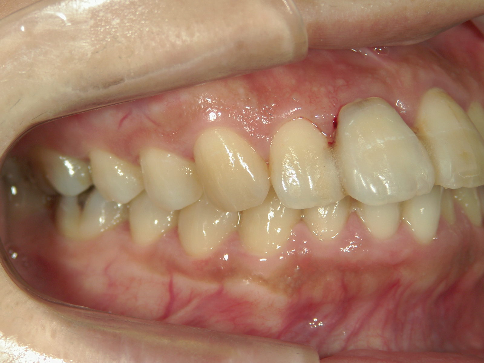 全顎ワイヤー矯正　症例（70）