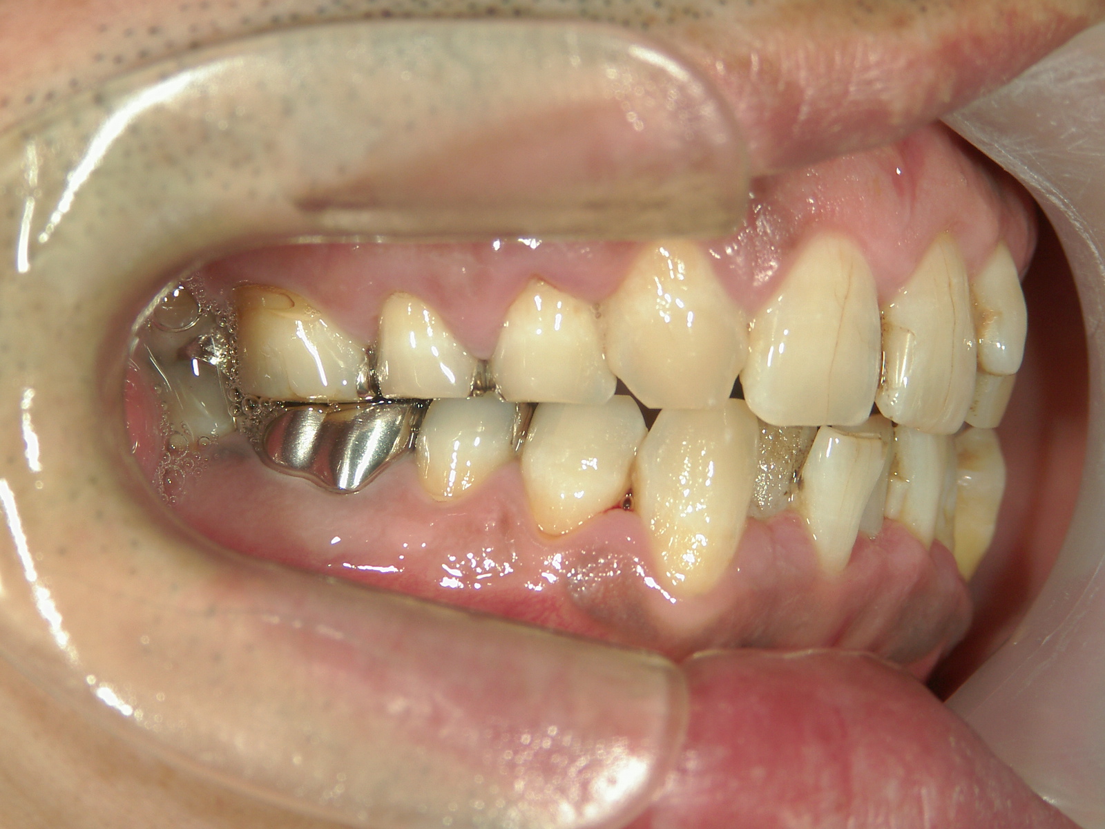 全顎ワイヤー矯正　症例（72）