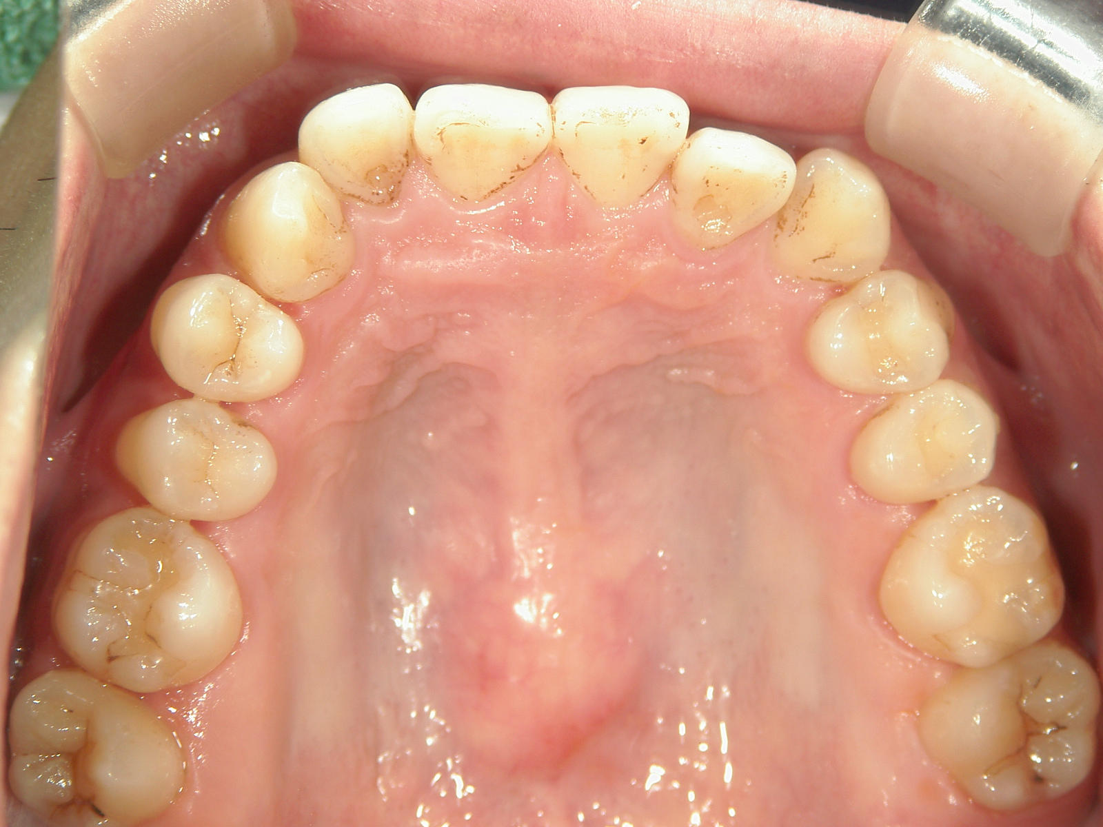 非抜歯症例（3） | 浜松市で矯正治療の期間のご相談ならいとう歯科矯正