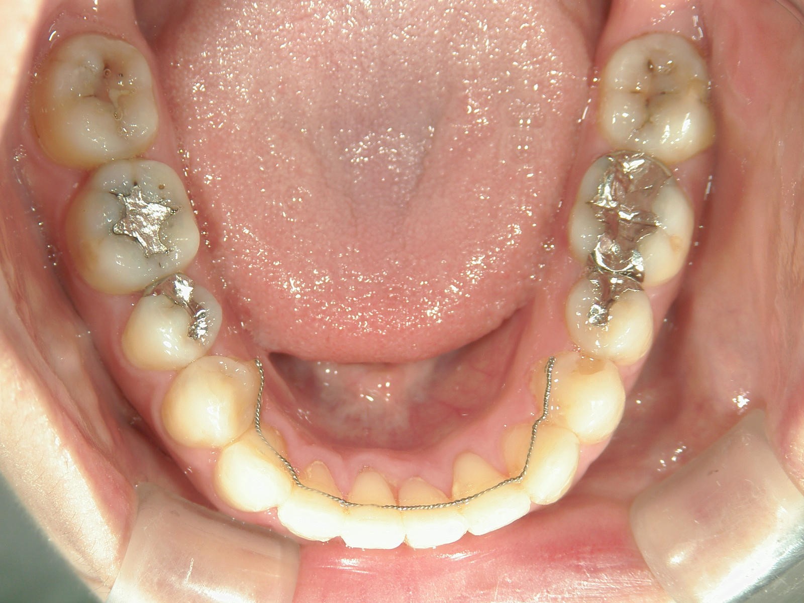 非抜歯症例（6）