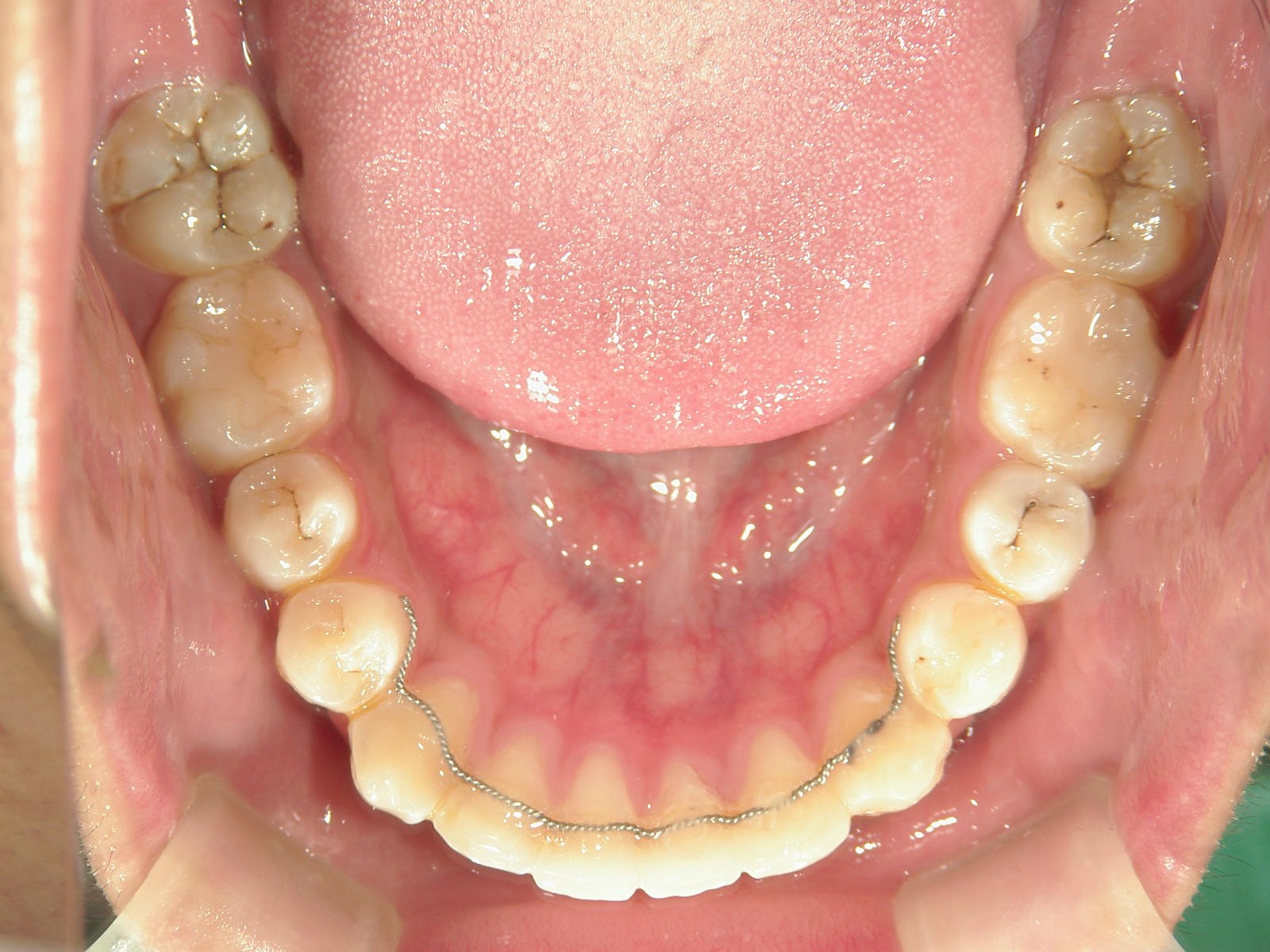 非抜歯症例（9）