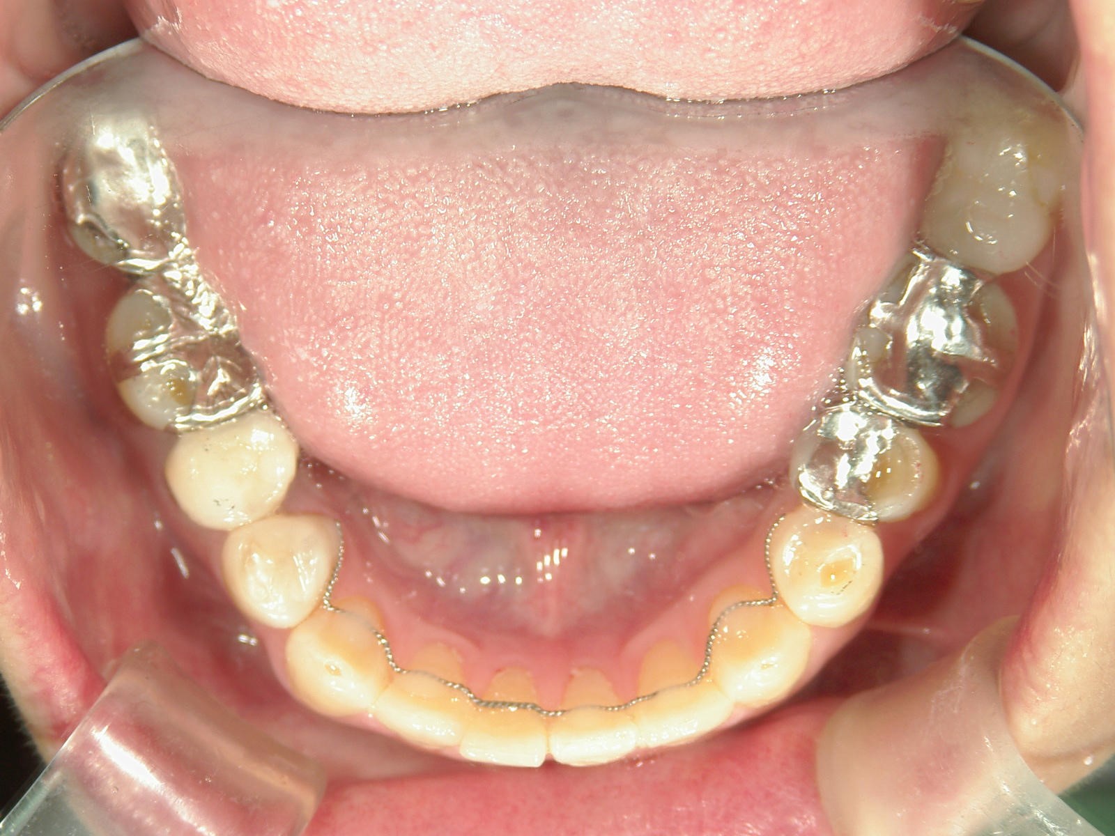 非抜歯症例（10）