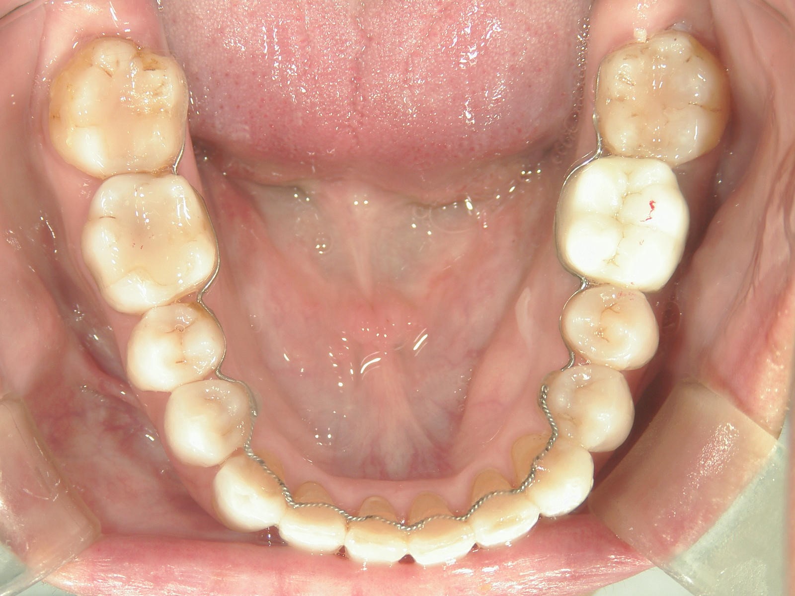 非抜歯症例（12）