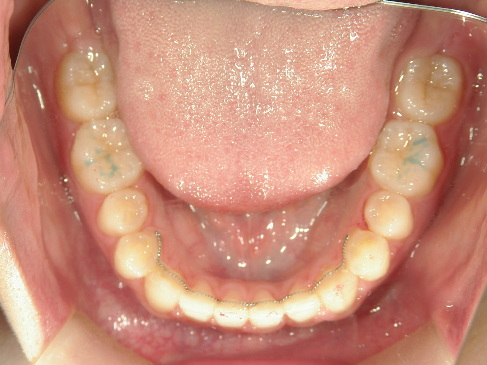 非抜歯症例（13）