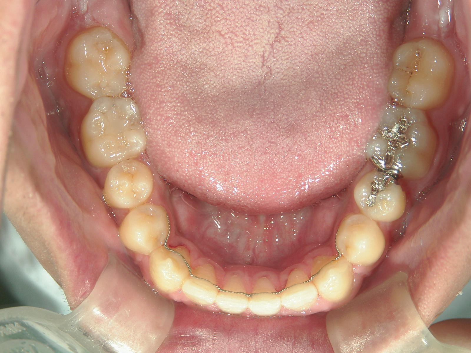 全顎ワイヤー矯正　症例（69）