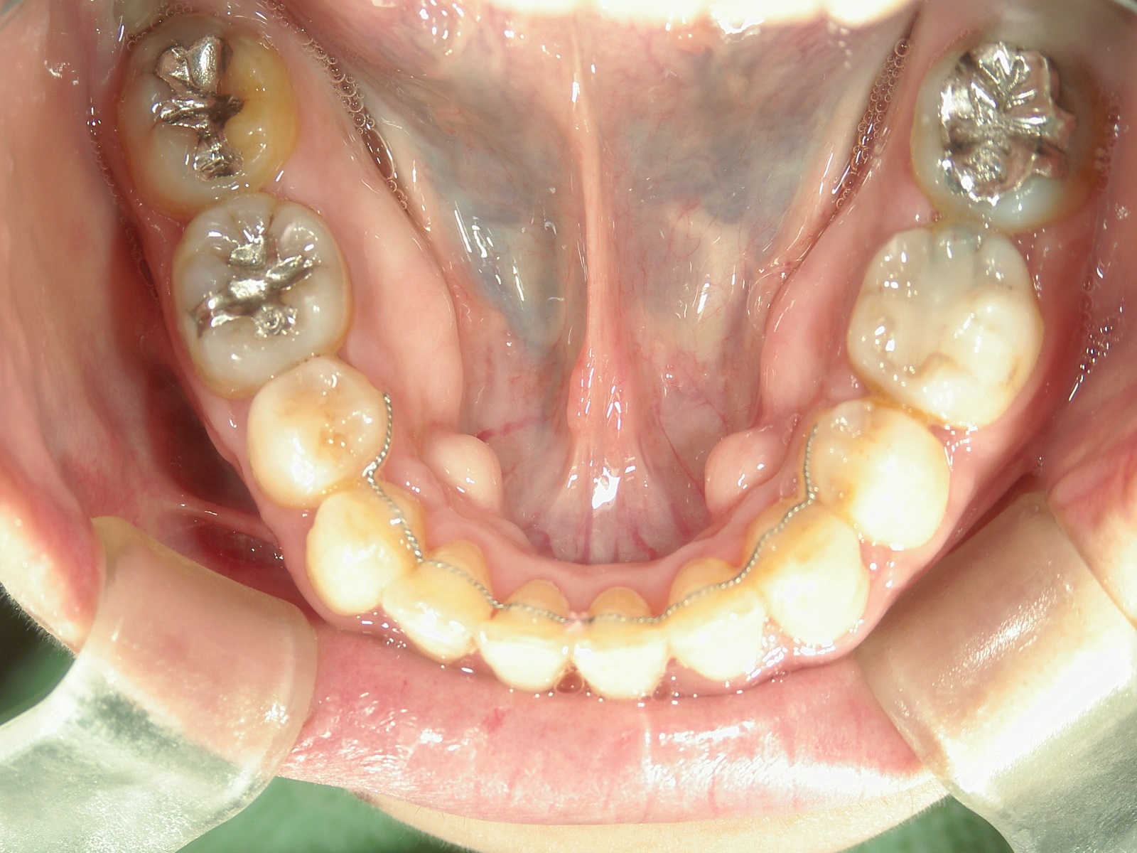 全顎ワイヤー矯正　症例（70）