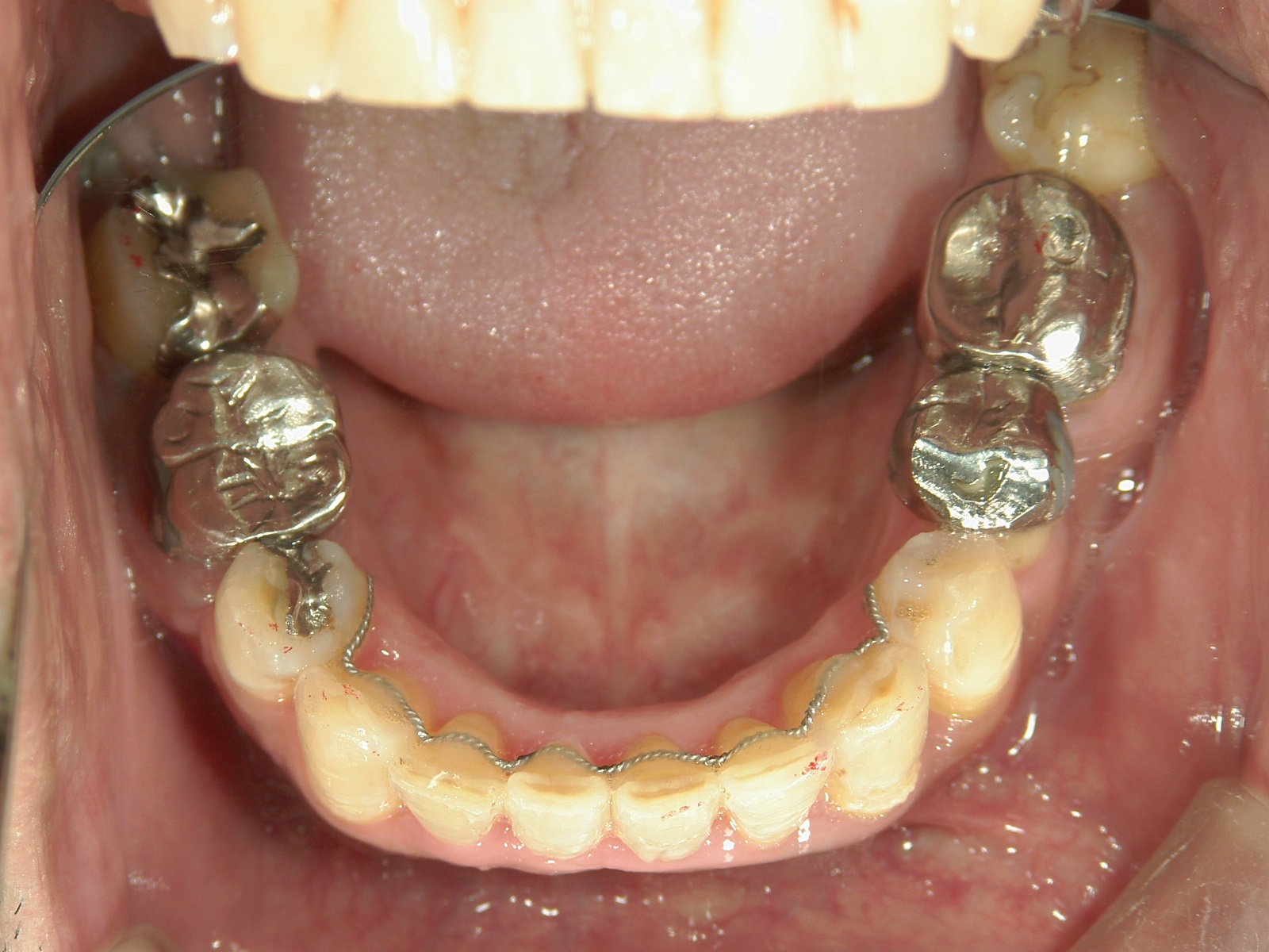 全顎ワイヤー矯正　症例（72）