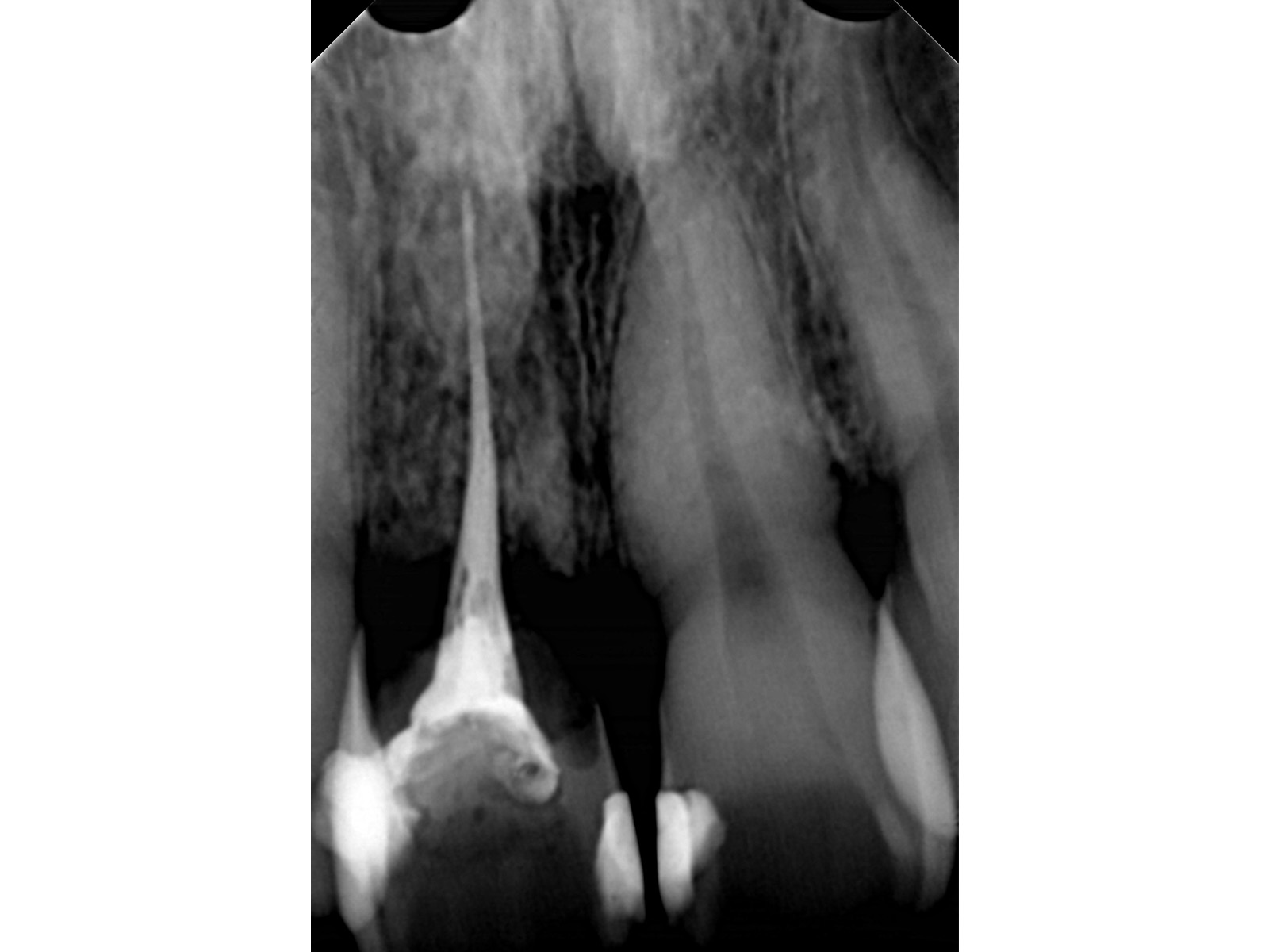 全顎ワイヤー矯正　症例（70）