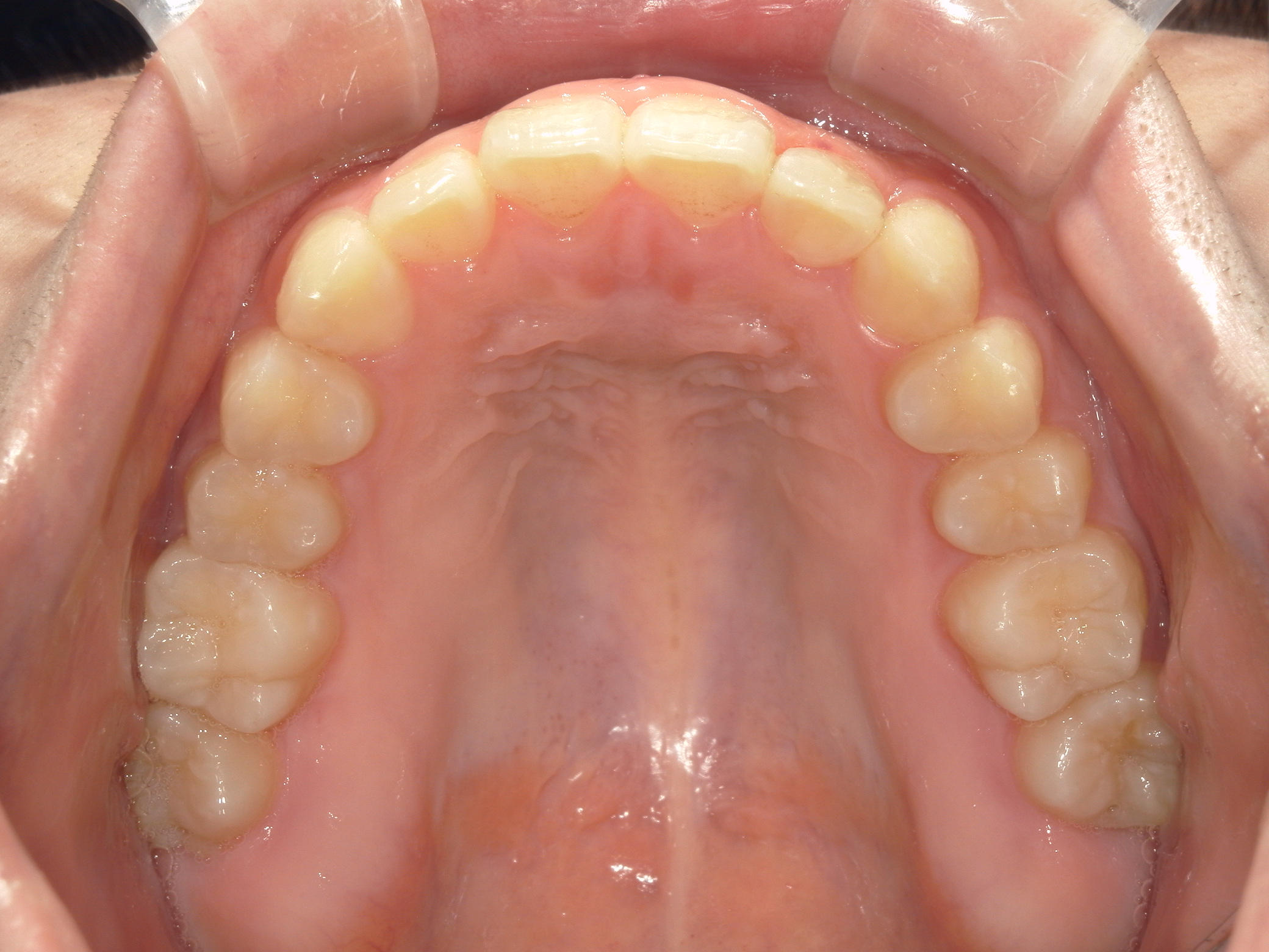 インビザライン矯正　症例（19）