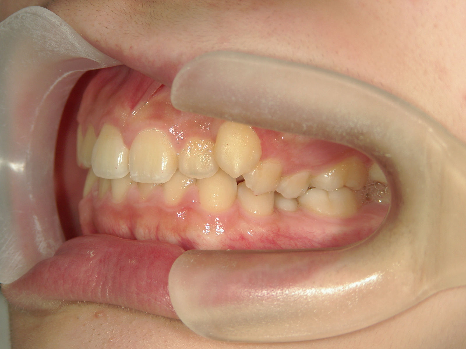 インビザライン矯正　症例（19）