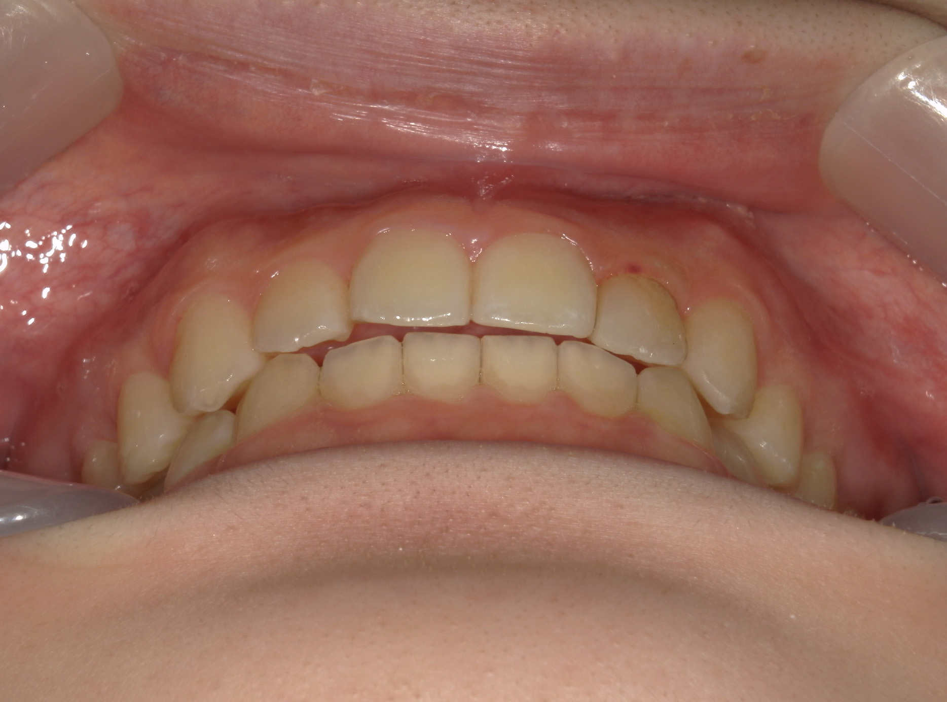 インビザライン矯正　症例（19）