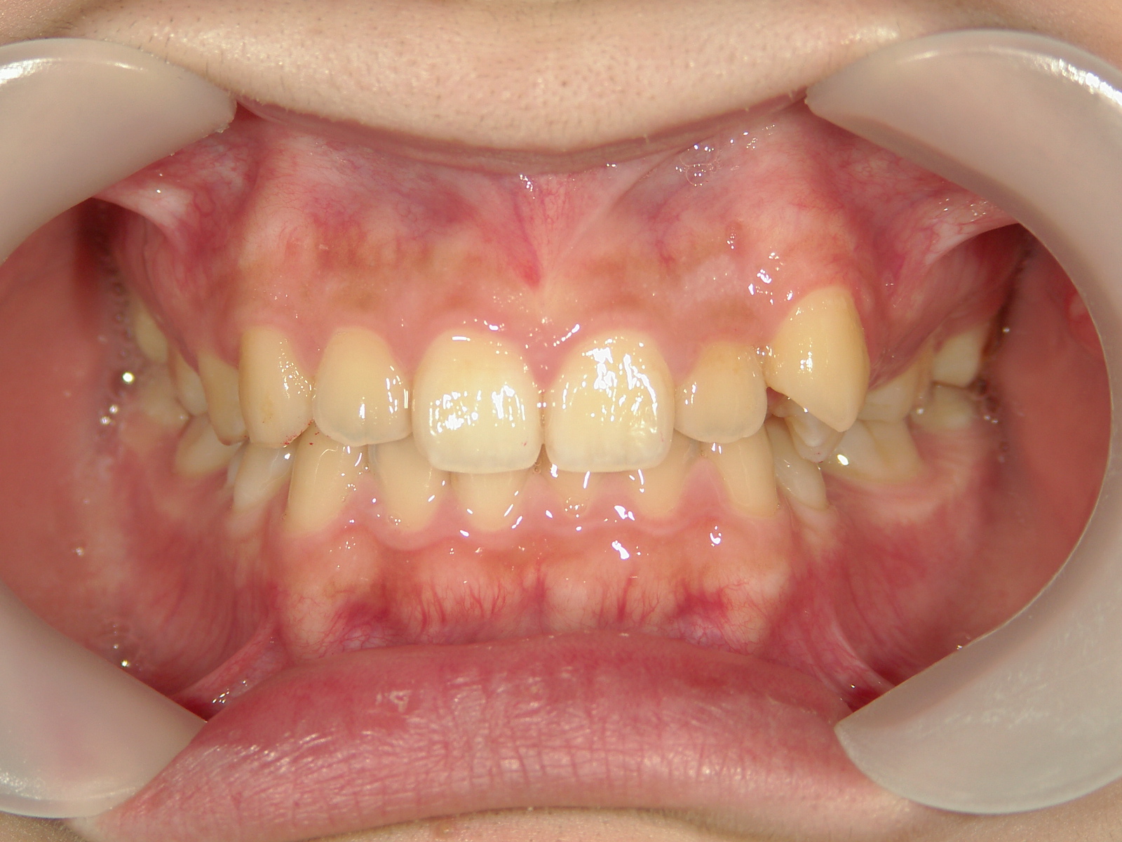 インビザライン矯正　症例（19）