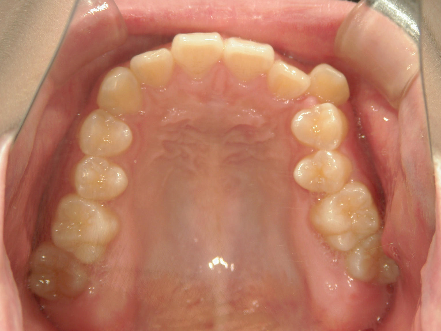 インビザライン矯正　症例（19）