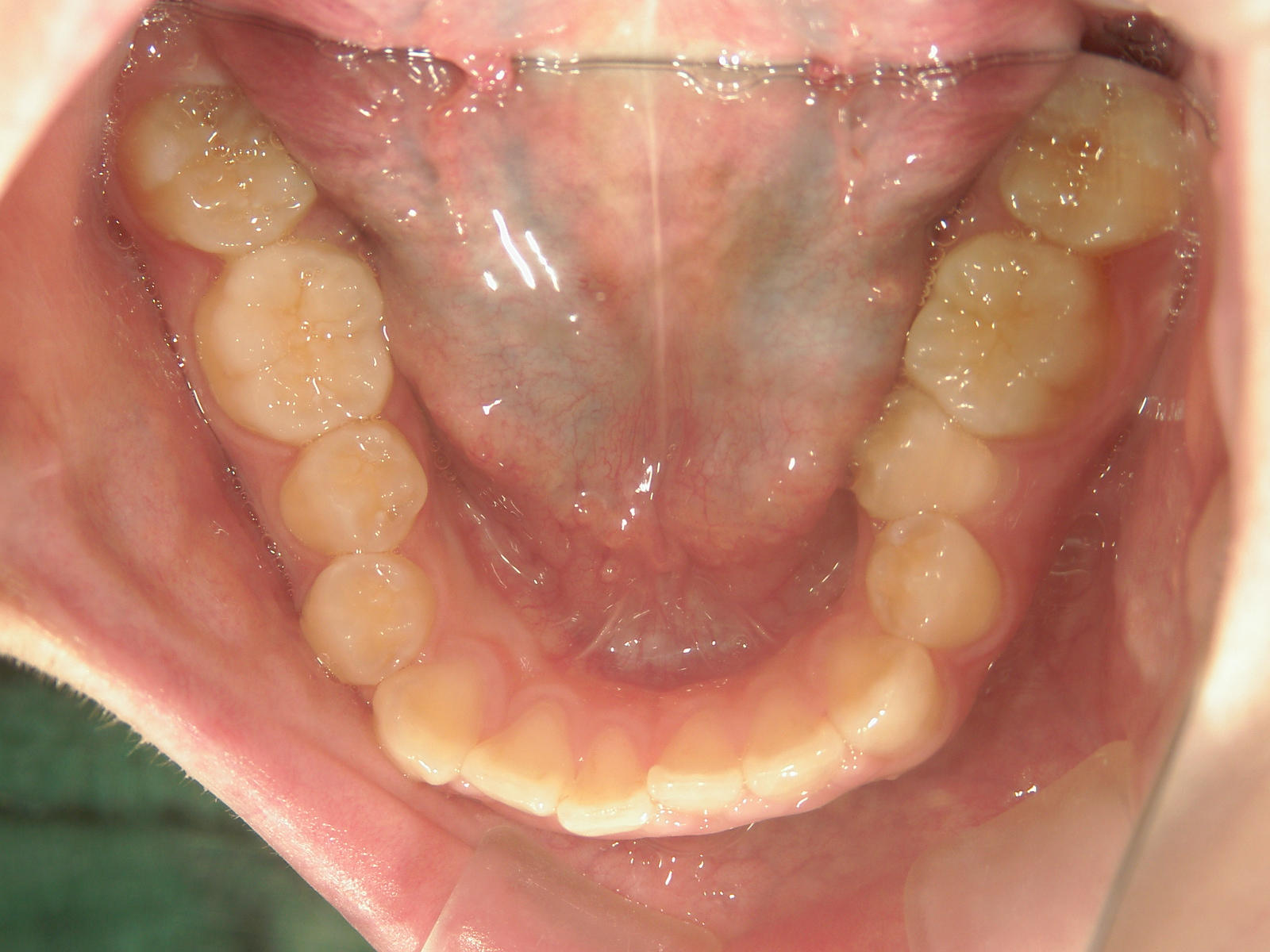 インビザライン矯正　症例（19）