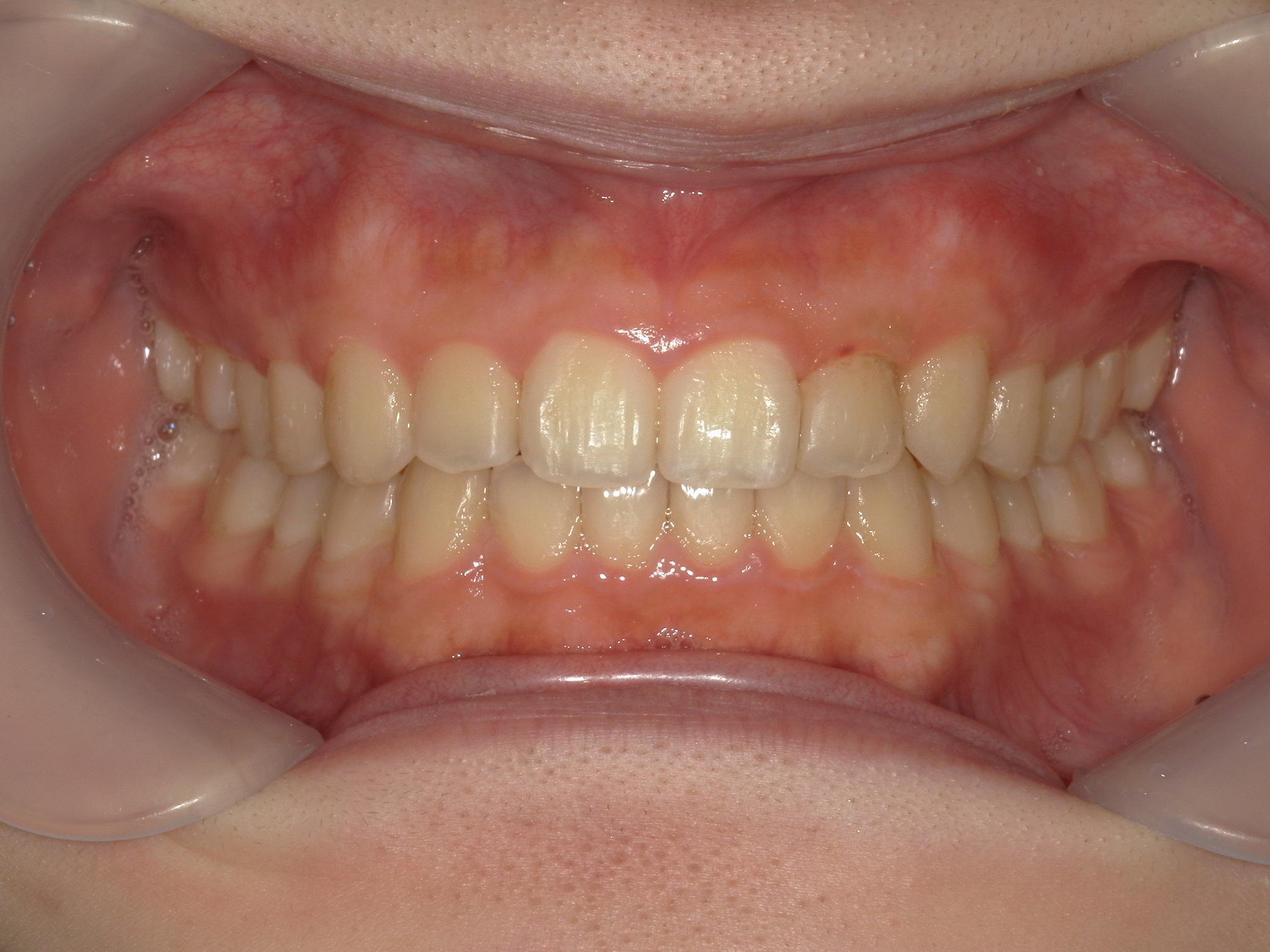 インビザライン矯正　症例（19）