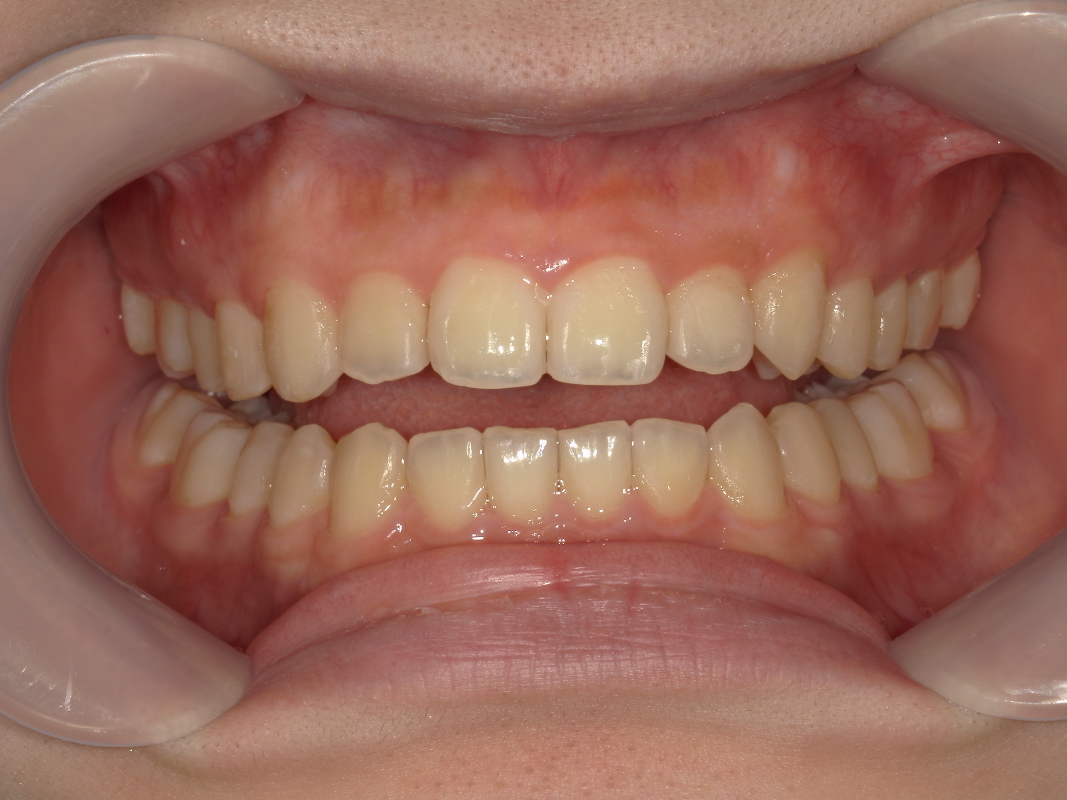 インビザライン矯正　症例（19）