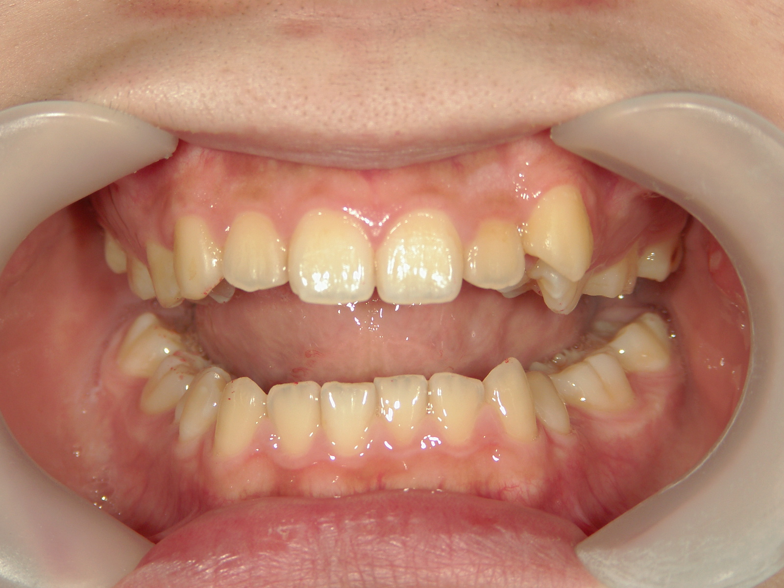 インビザライン矯正　症例（19）