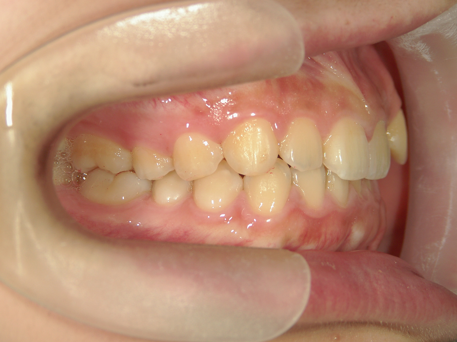 インビザライン矯正　症例（19）