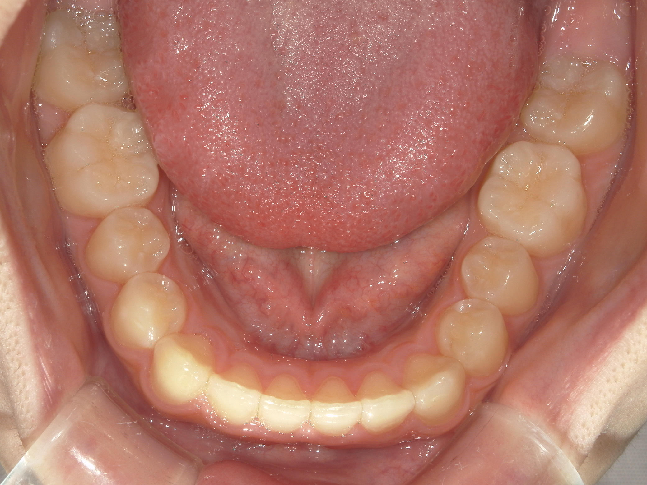 インビザライン矯正　症例（19）