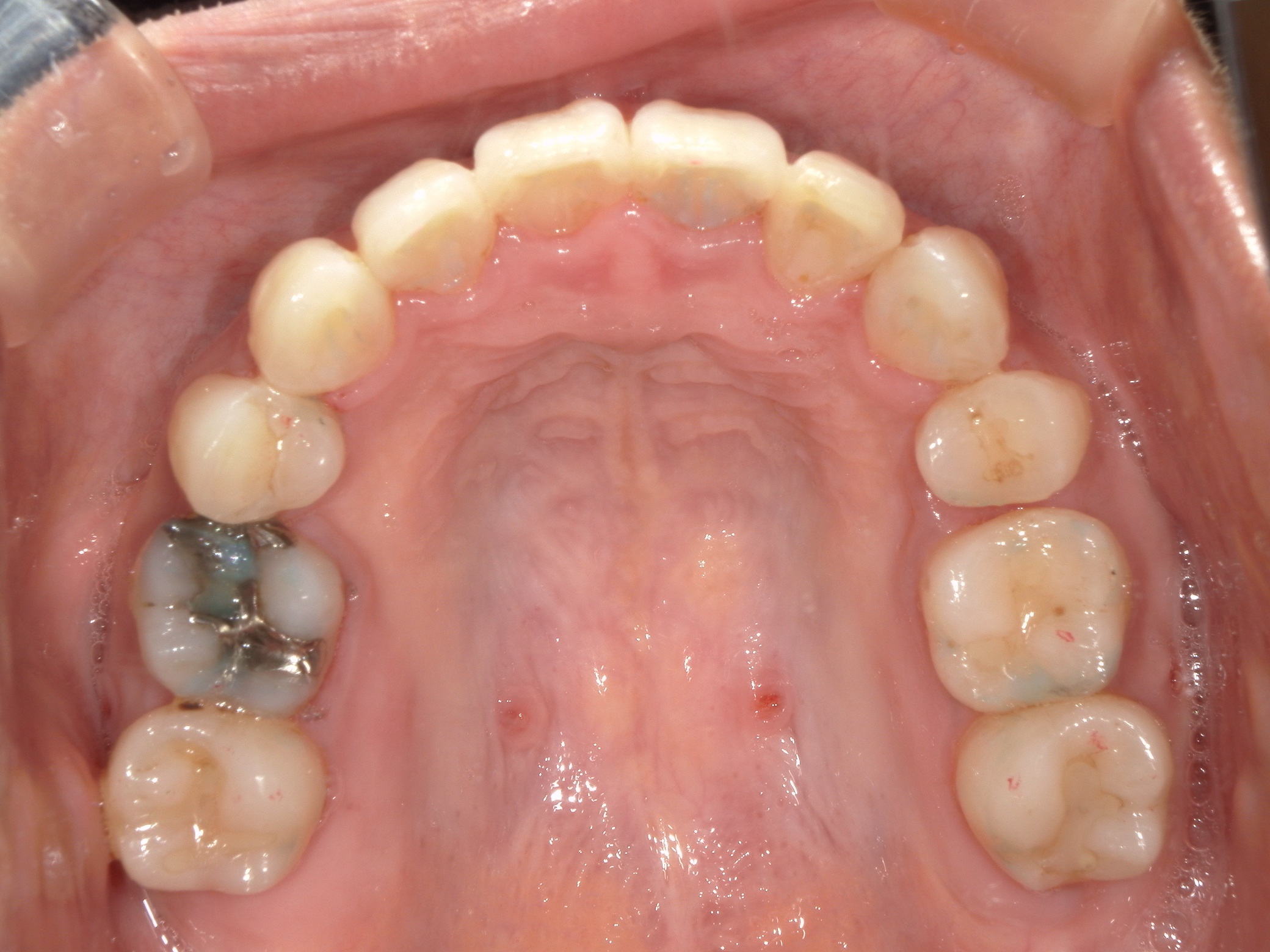 舌側ワイヤー矯正　症例（30）