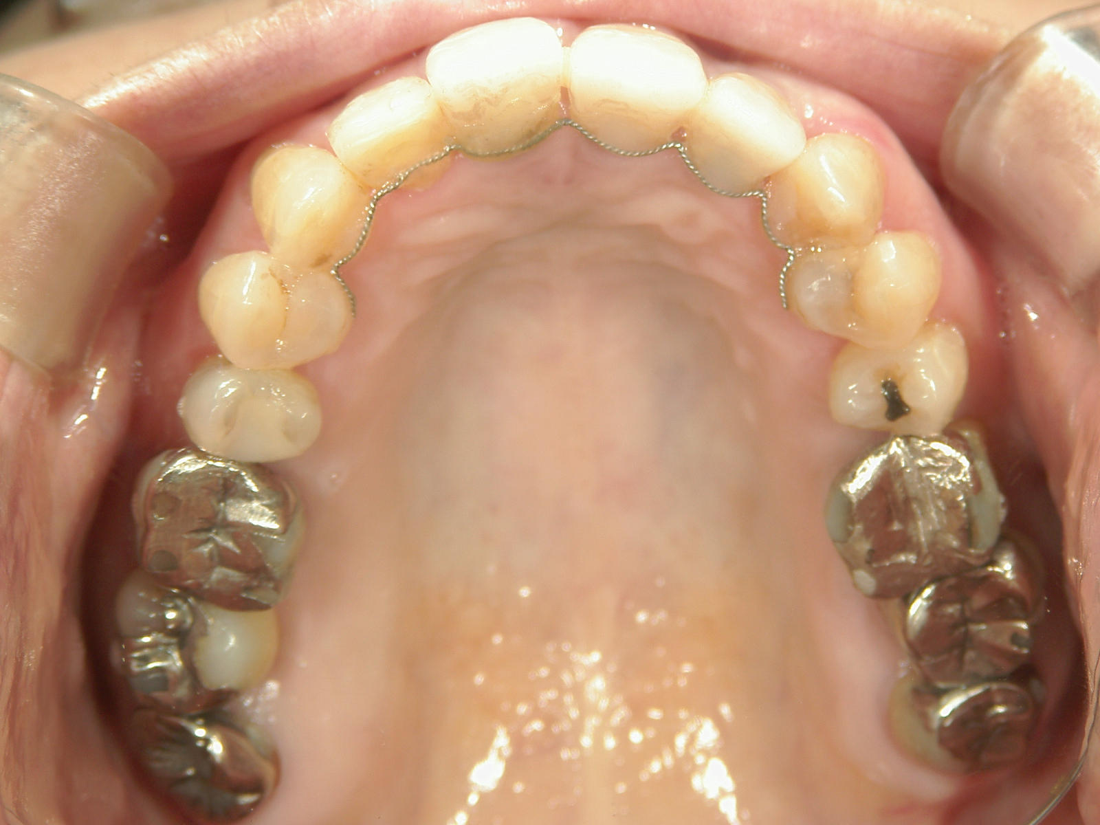 補綴併用症例（2）