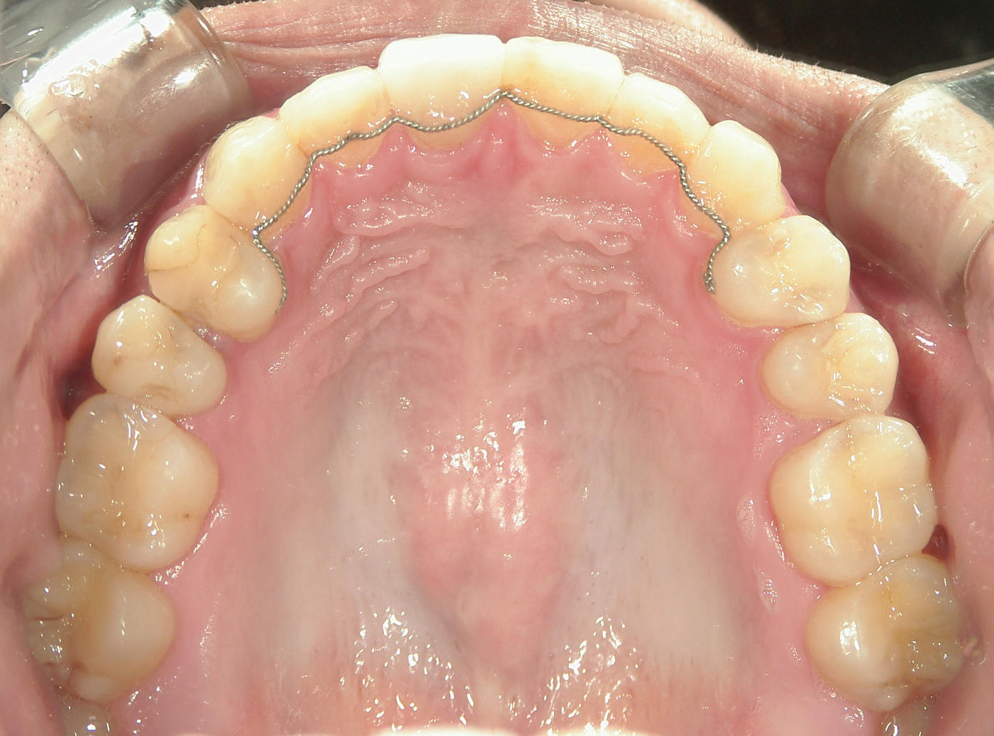 補綴併用症例（3）