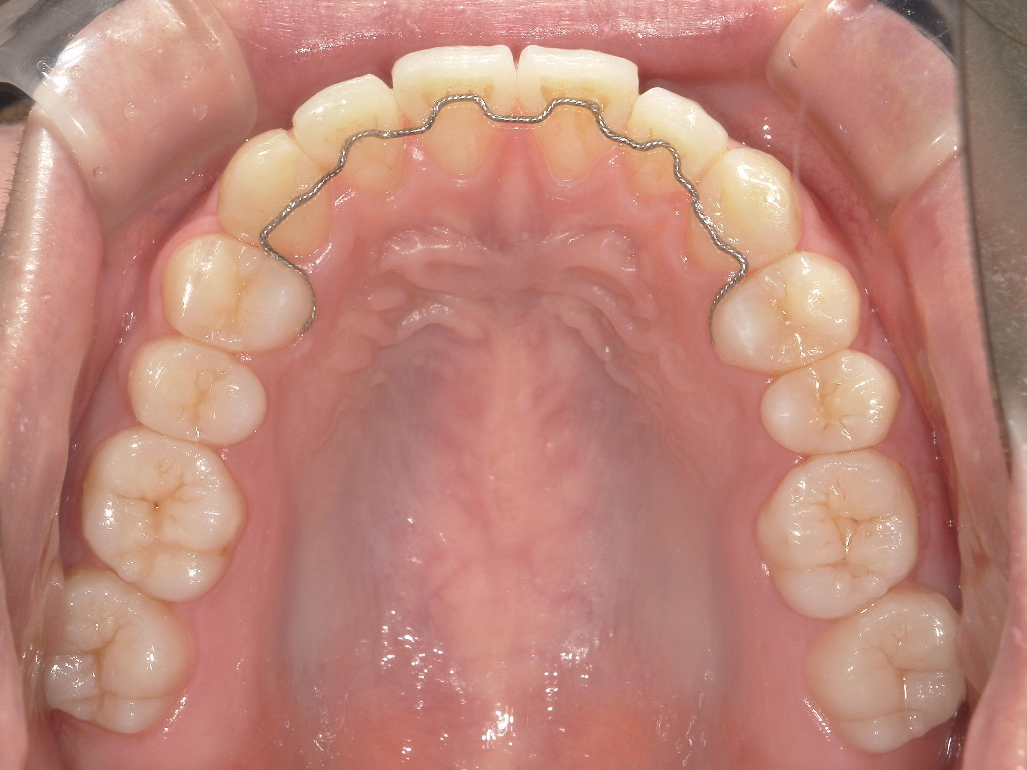 インビザライン矯正　症例（22）