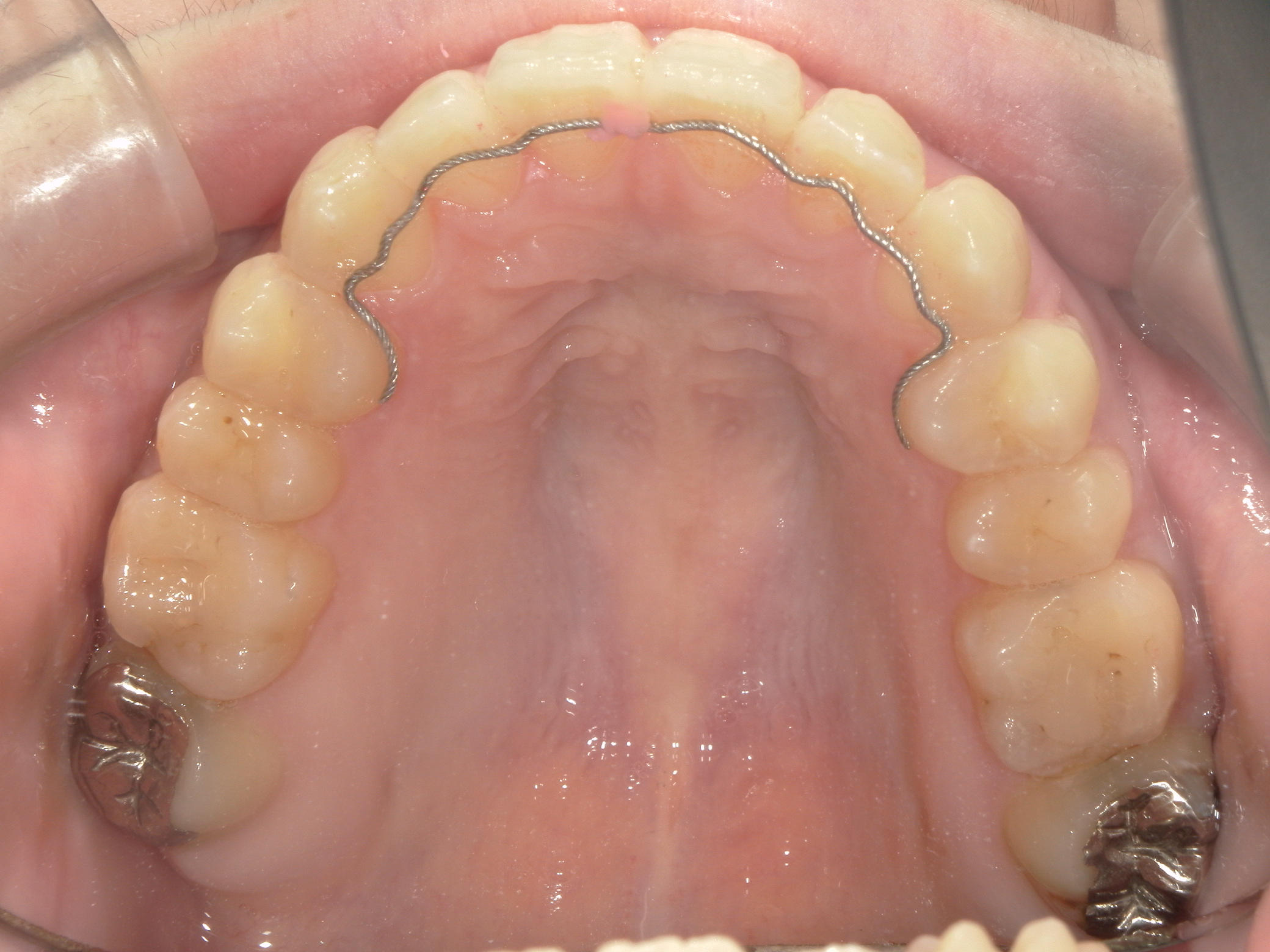 インビザライン矯正　症例（23）