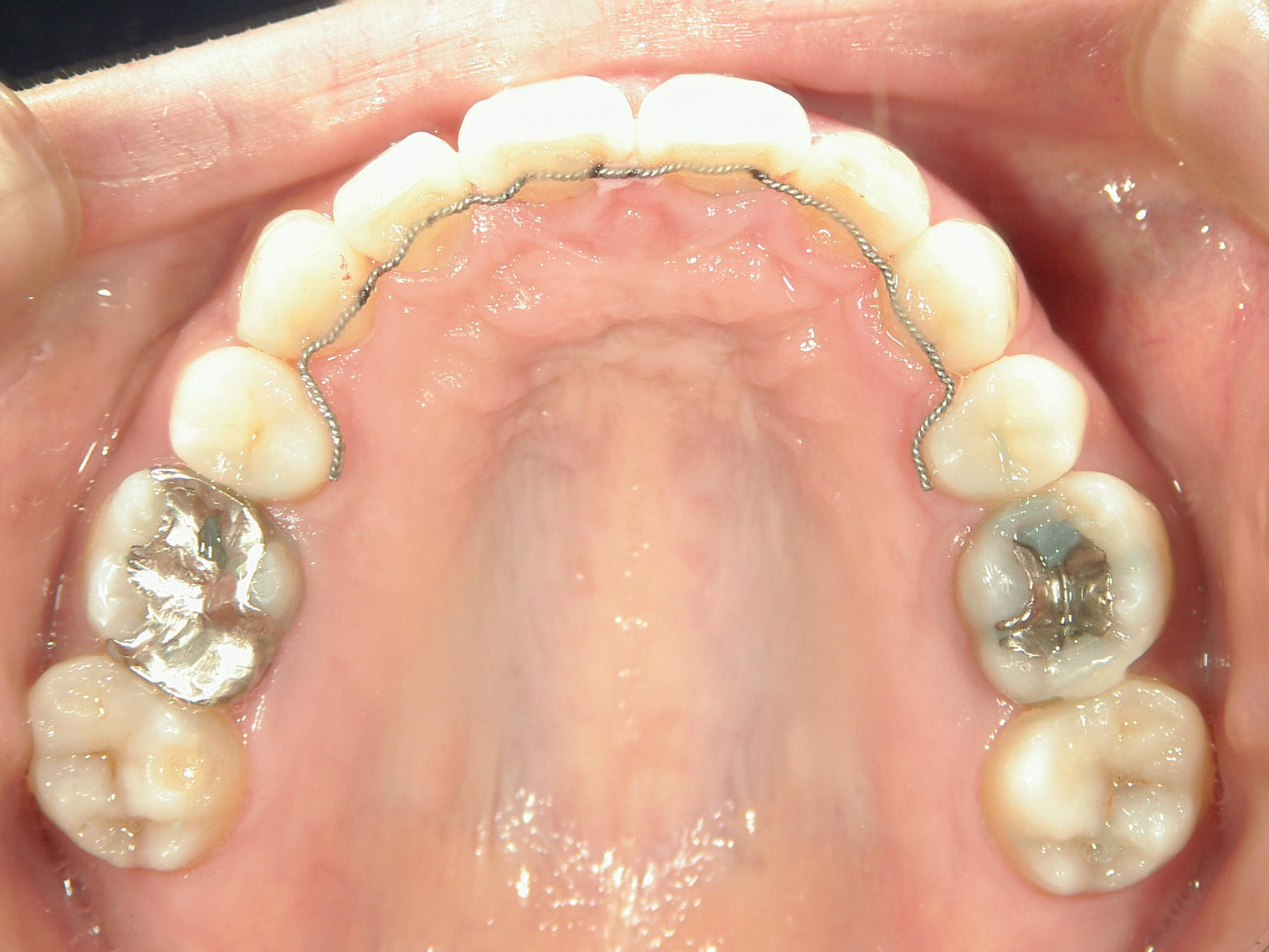 舌側ワイヤー矯正　症例（25）