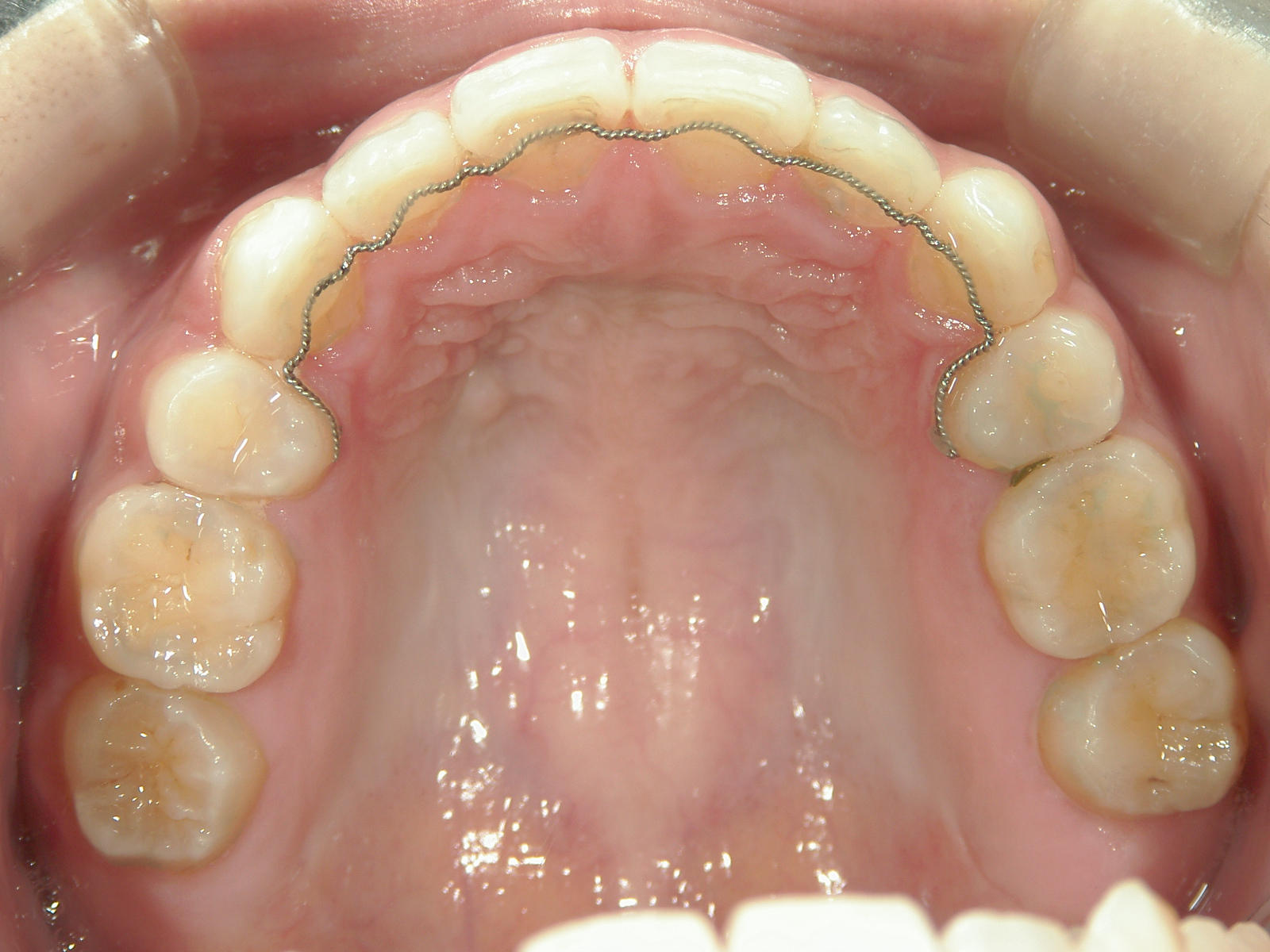 舌側ワイヤー矯正　症例（26）