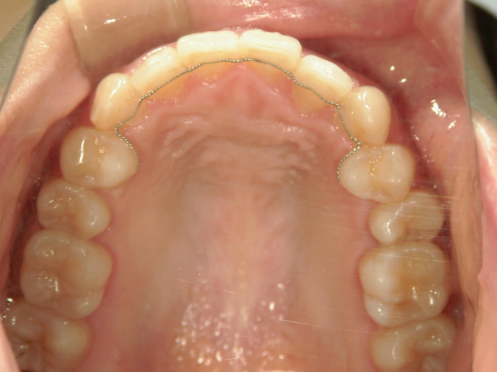 プチ舌側ワイヤー矯正　症例（27）