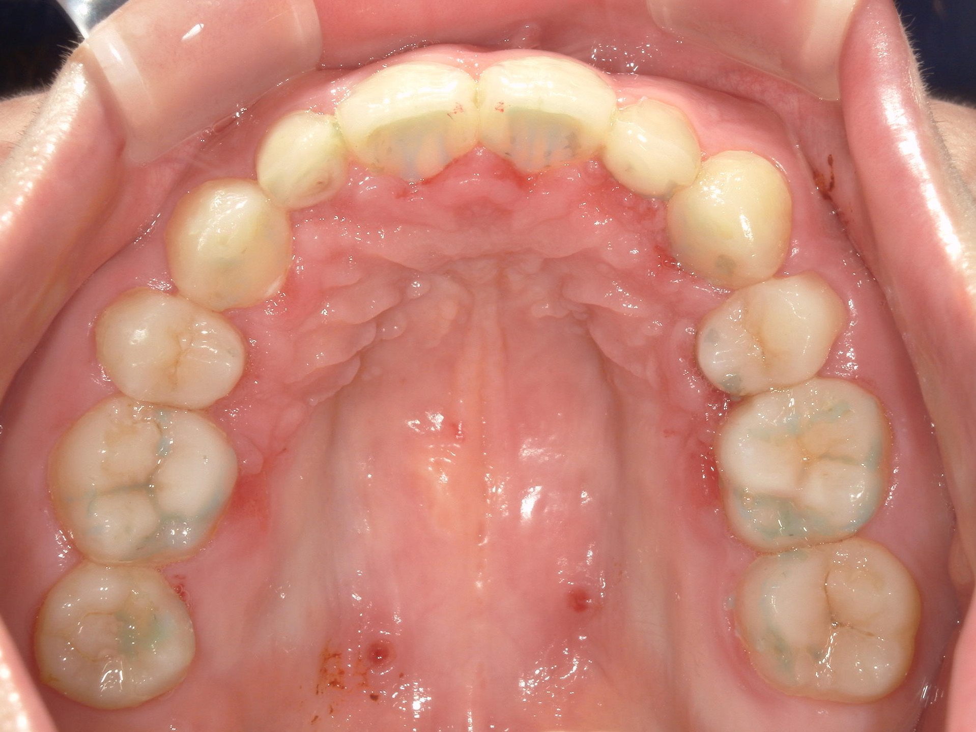 舌側ワイヤー矯正　症例（29）