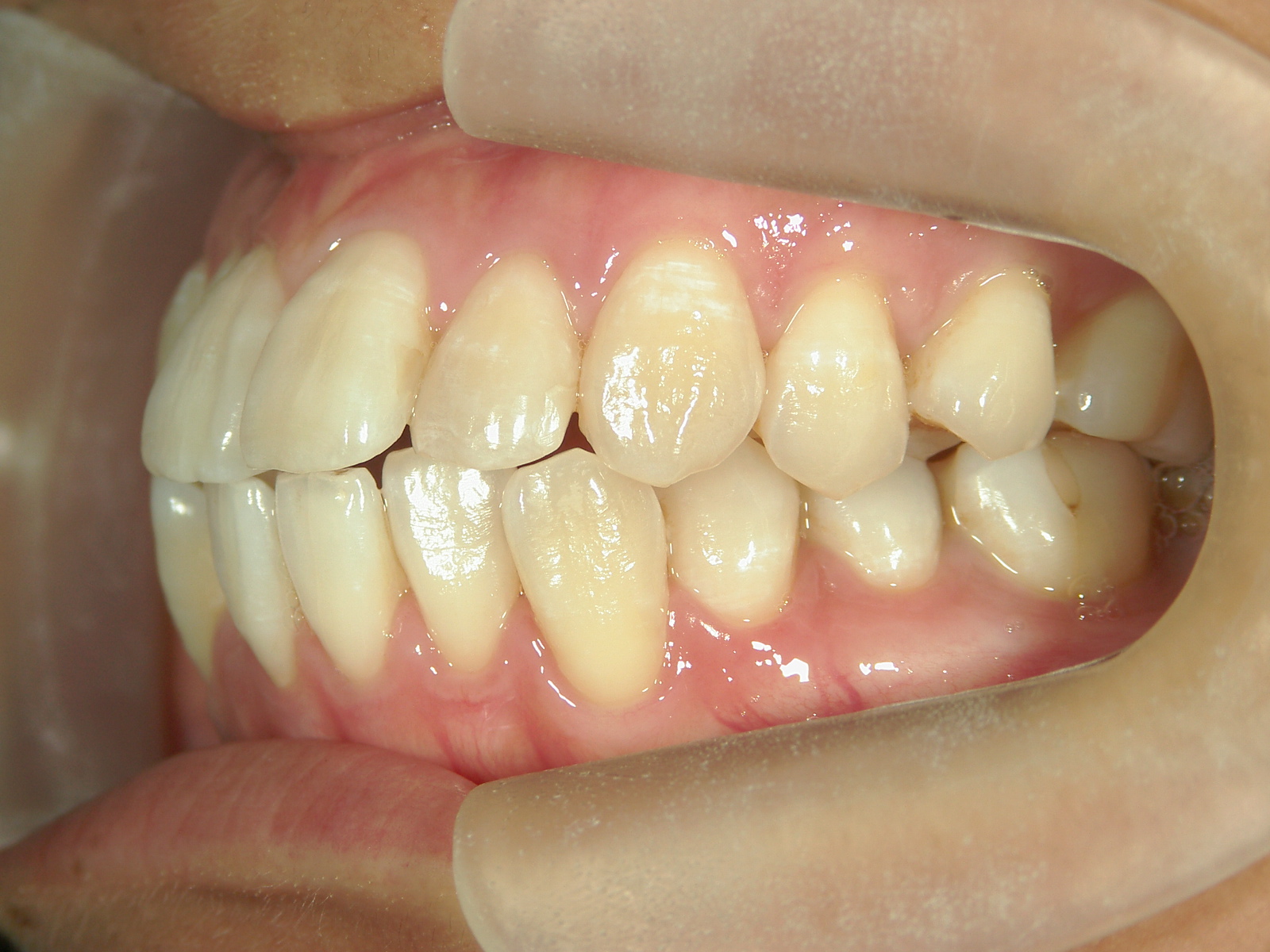 舌側ワイヤー矯正　症例（30）