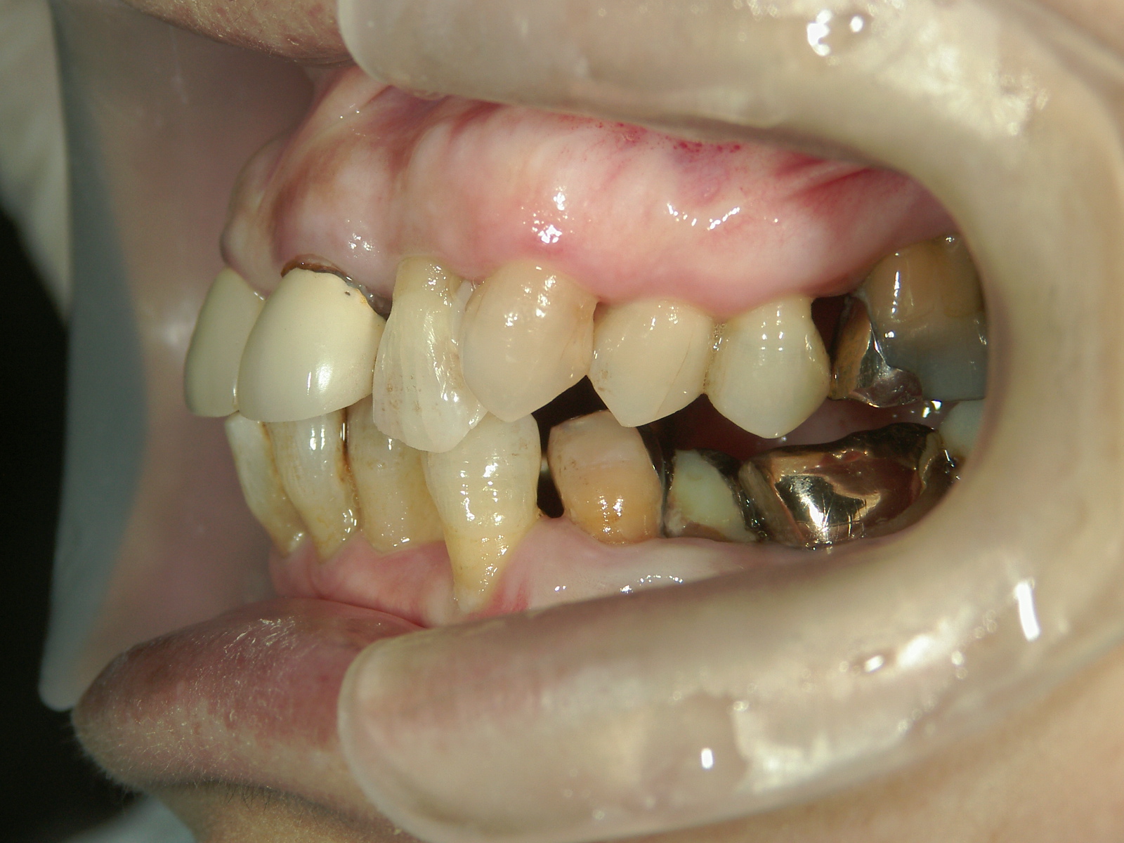 補綴併用症例（2）