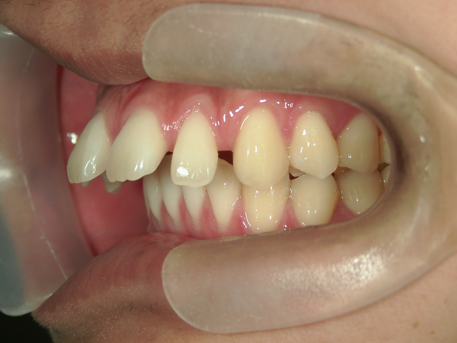 インビザライン矯正　症例（24）